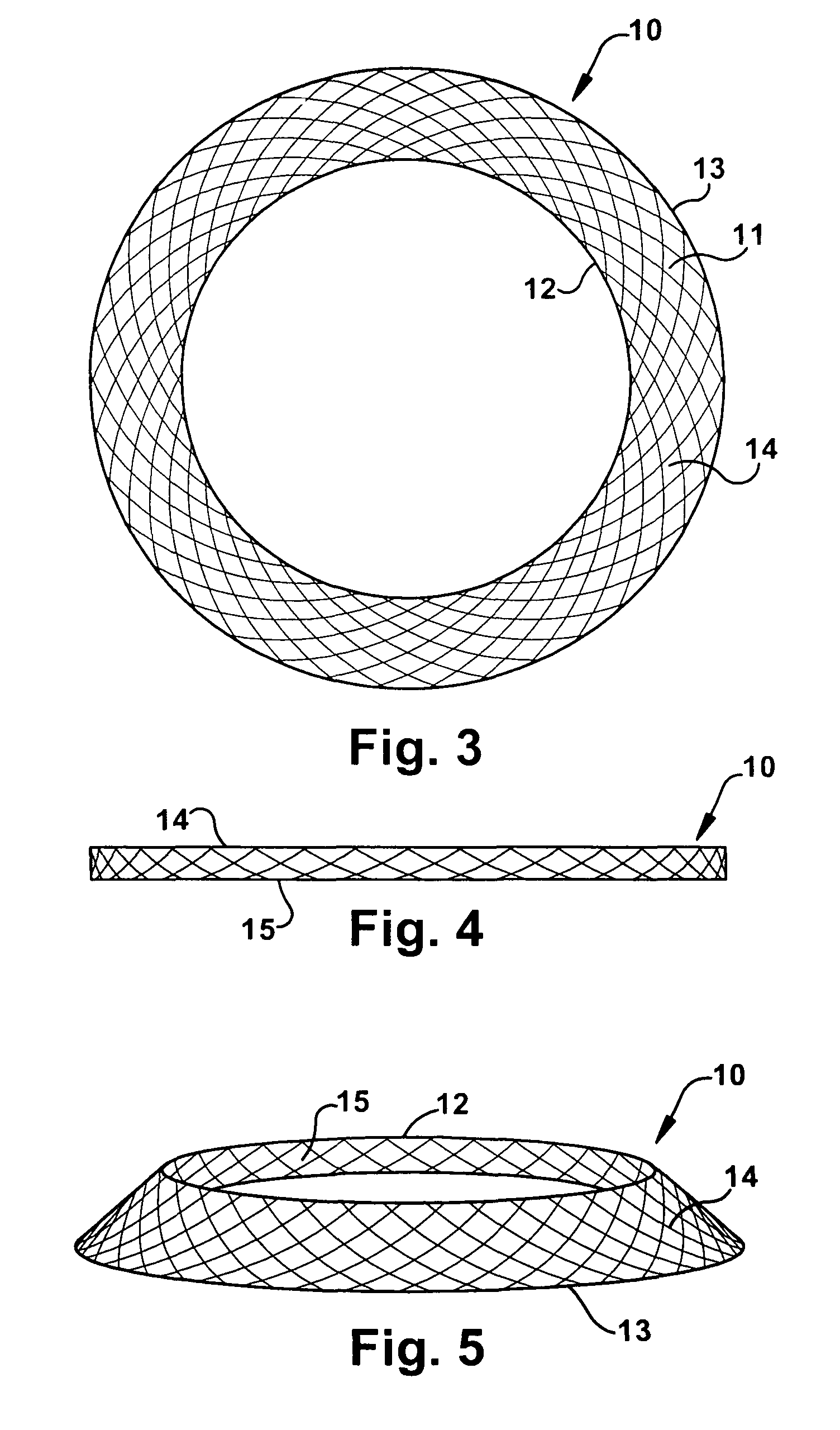 Implantable prosthesis for periareolar mastopexy