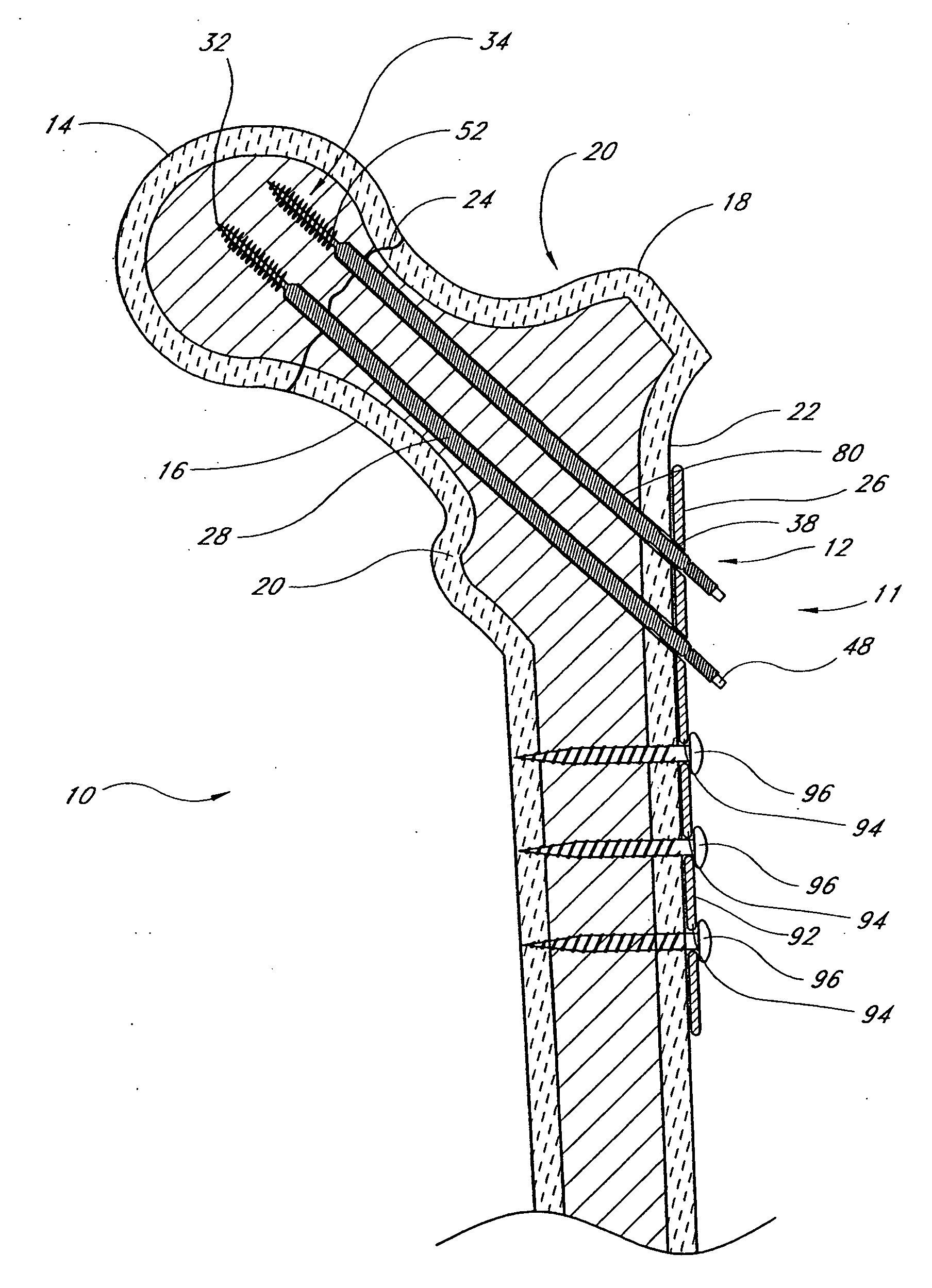 Locking plate for bone anchors