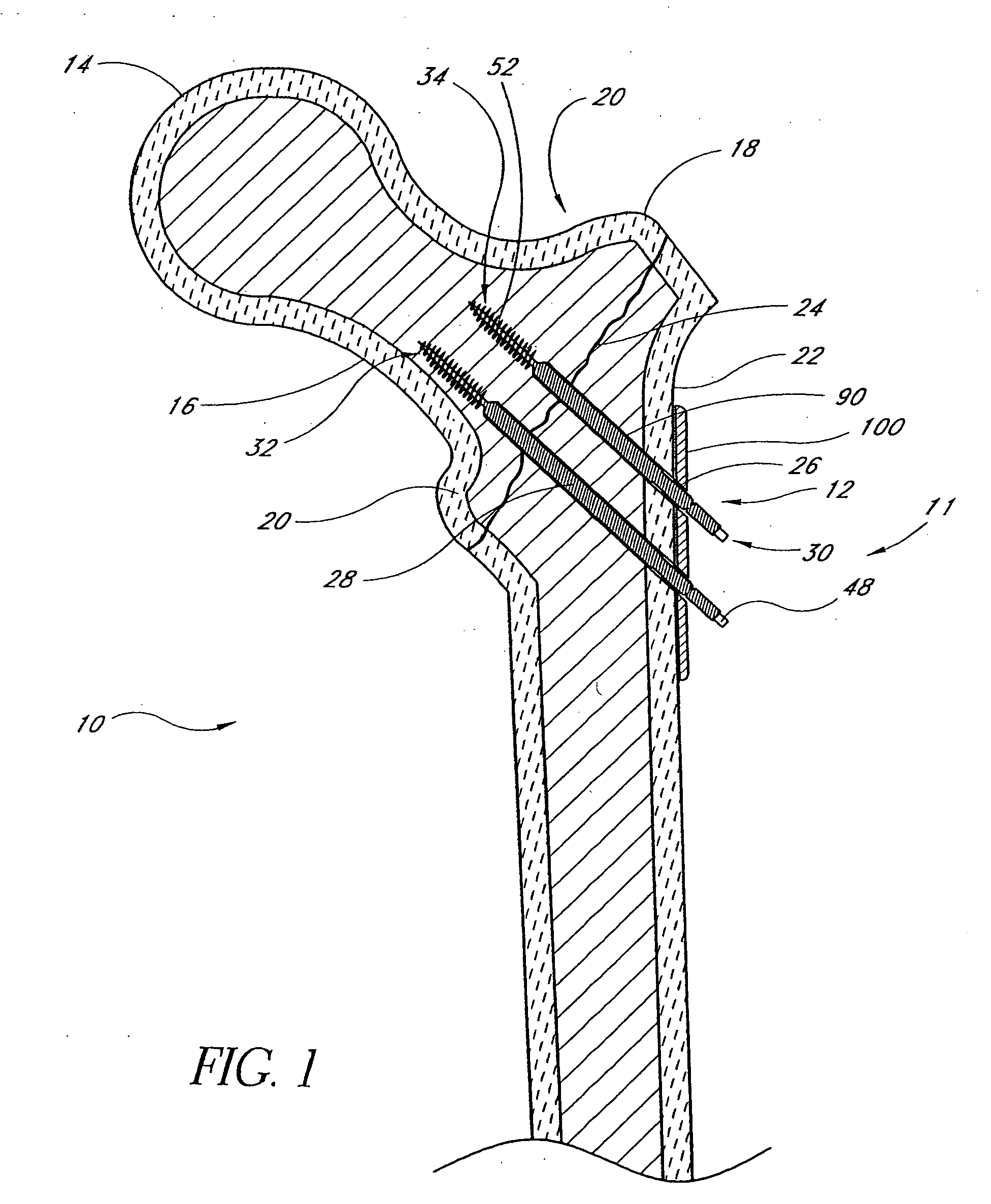 Locking plate for bone anchors