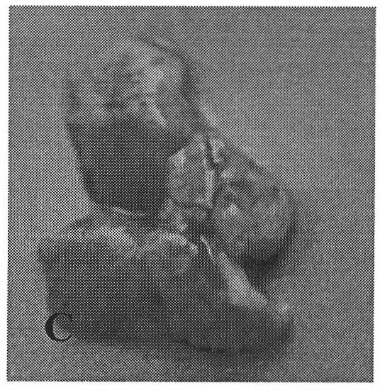 Highly metastatic model of human melanoma, cell subline, creation methods, and dynamic detection of metastasis