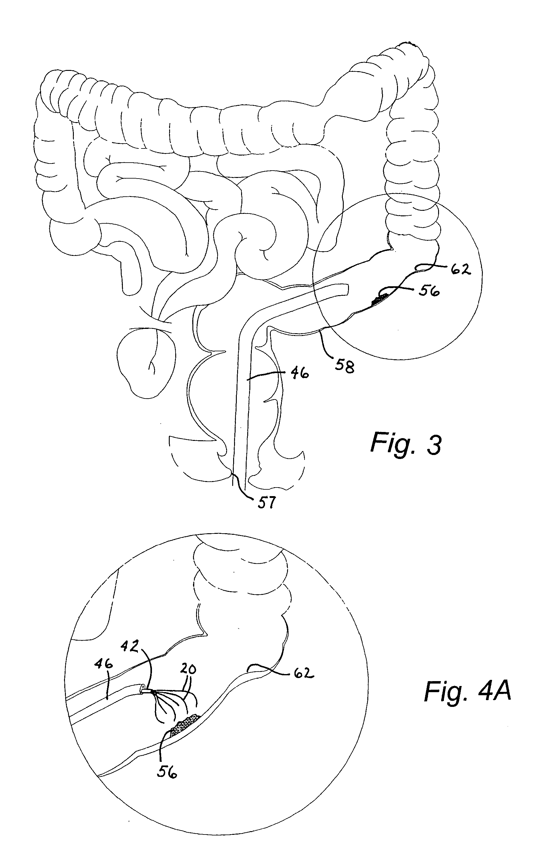 Medical instrument for fluid injection and related method