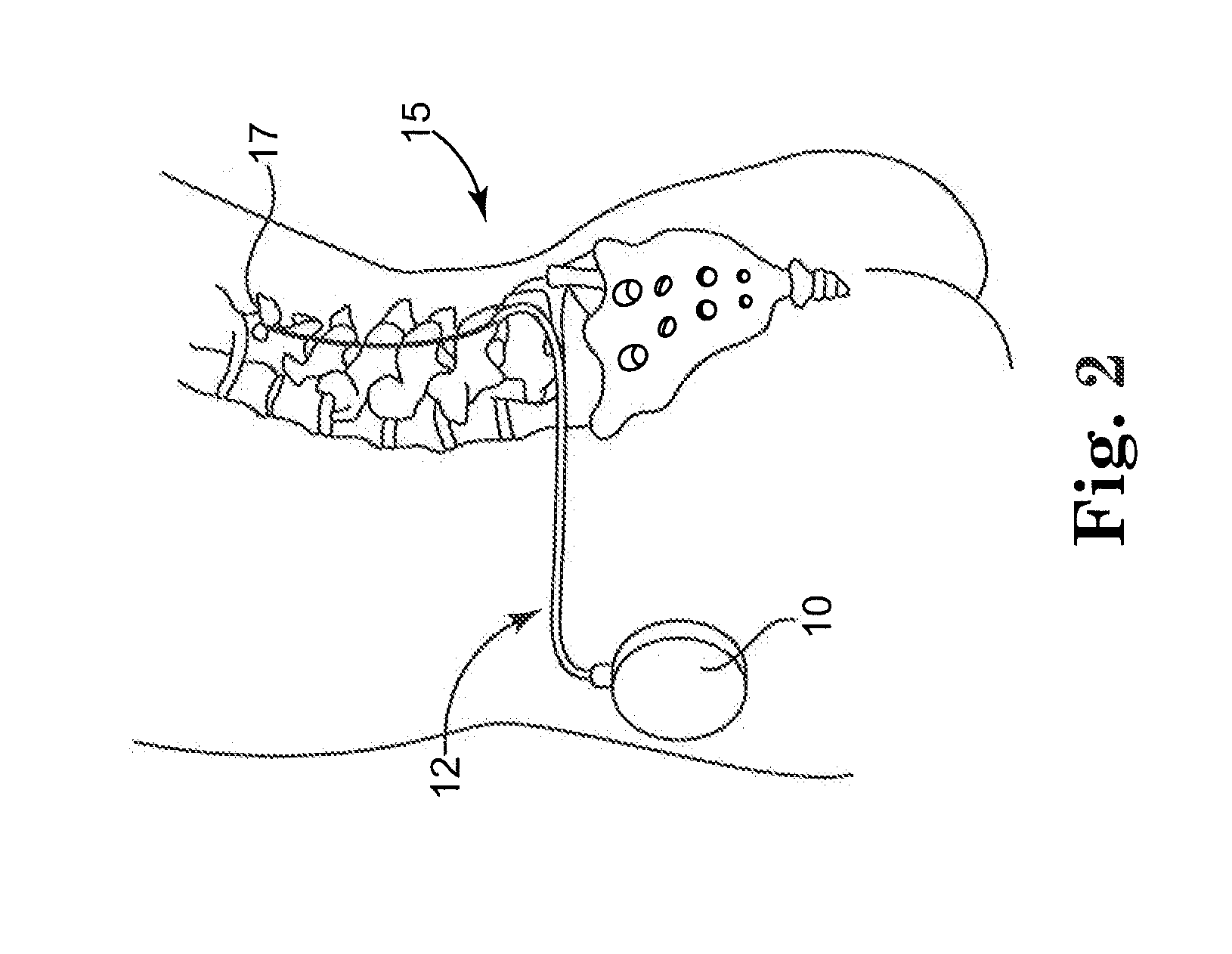 Controlling dead volume of a piston pump using an adjustment screw