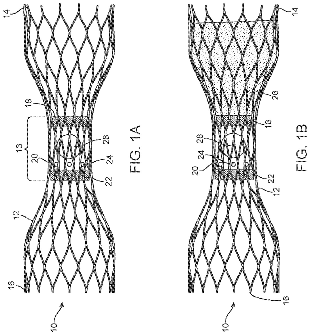 Vascular valve prosthesis