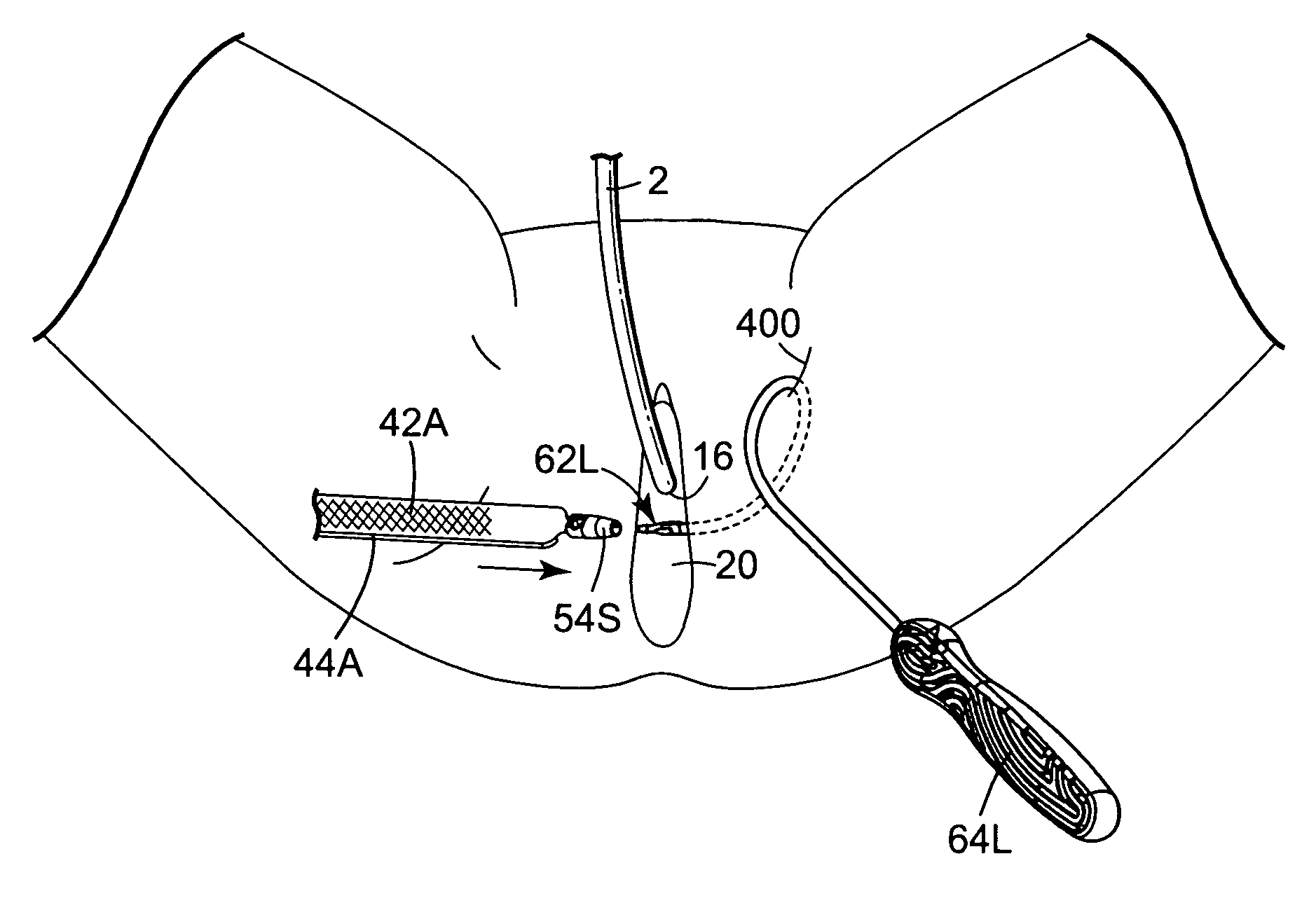 Transobturator surgical articles and methods