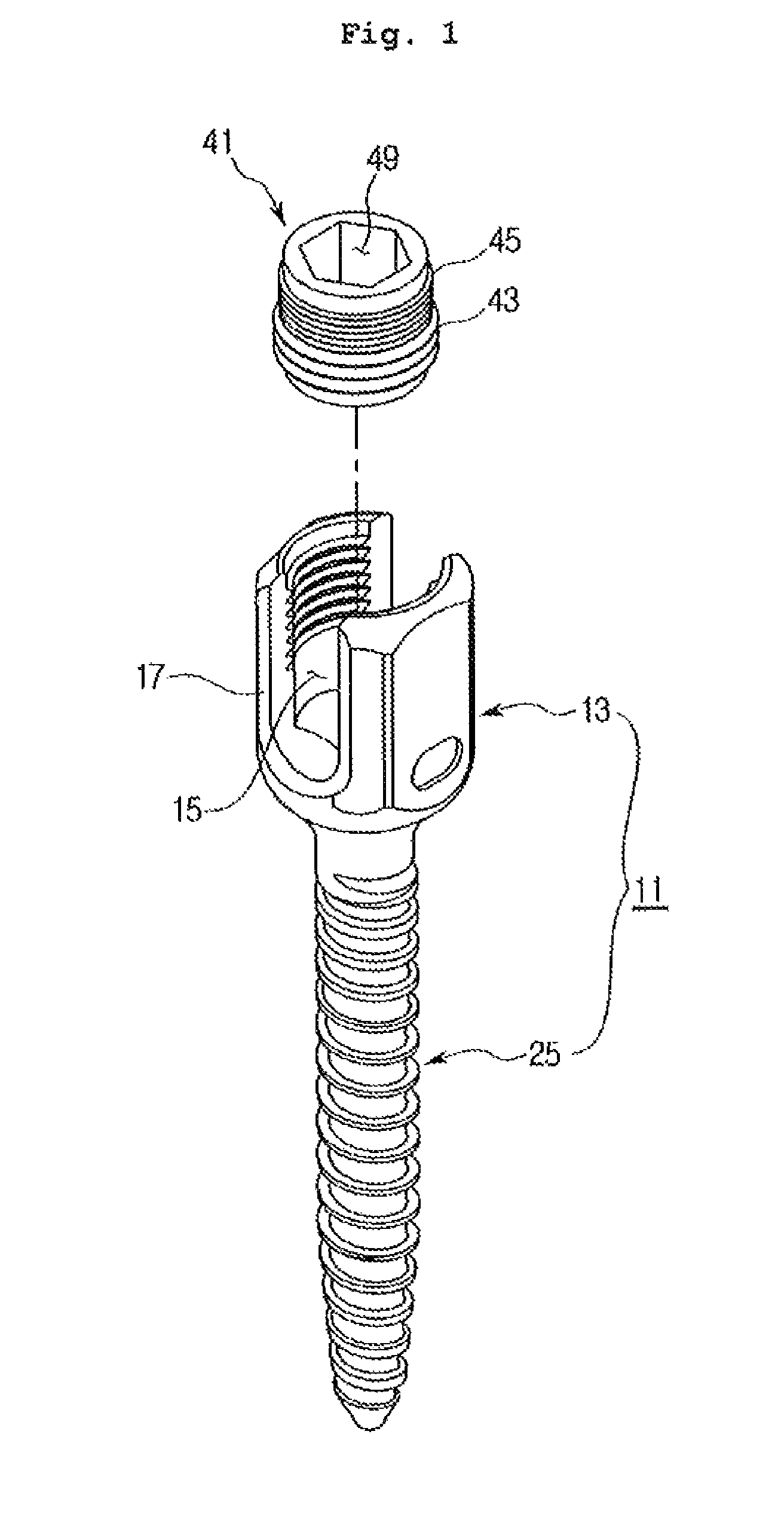 Spine fixation device containing set screw having double spiral form