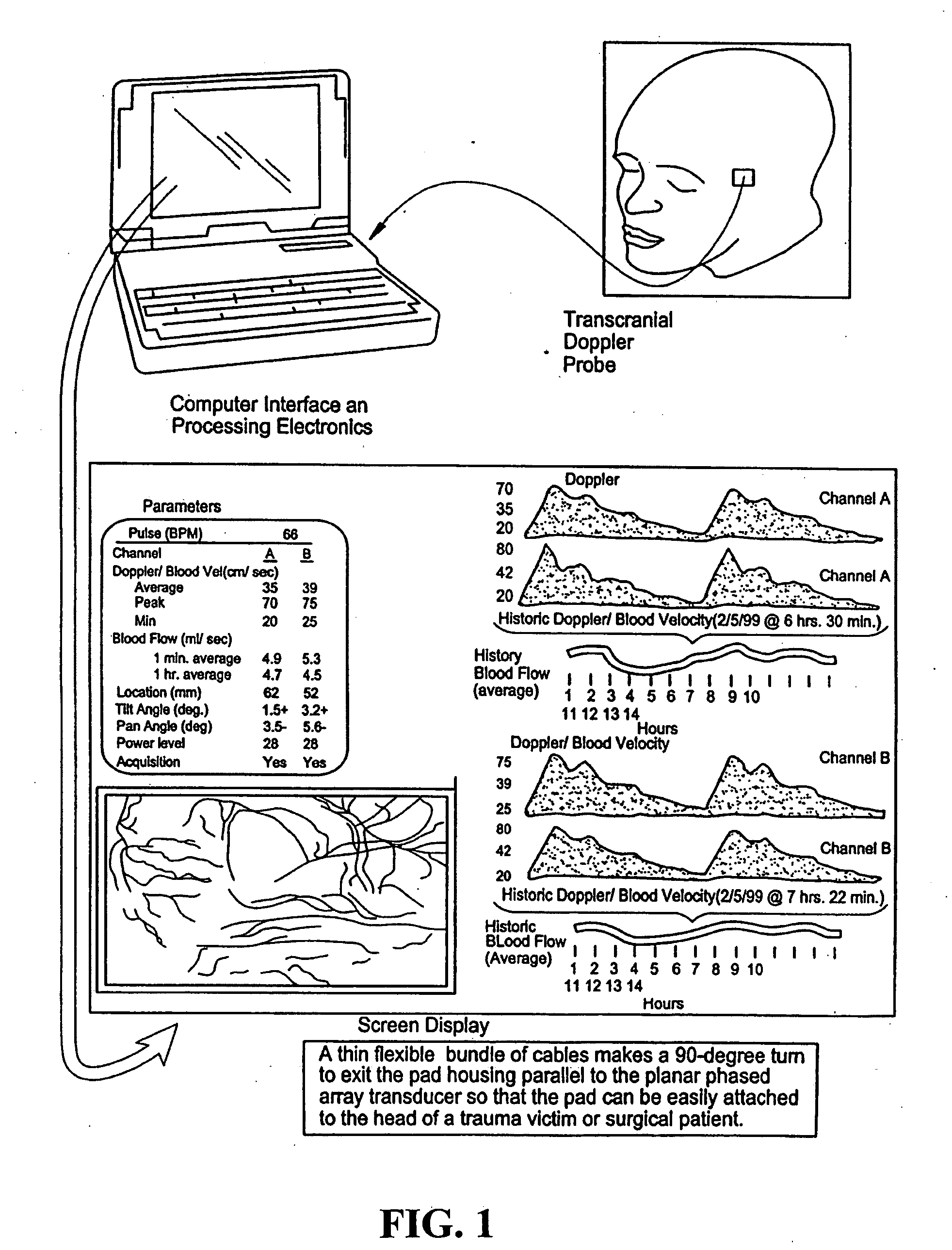 Devices and methods for tracking blood flow and determining parameters of blood flow