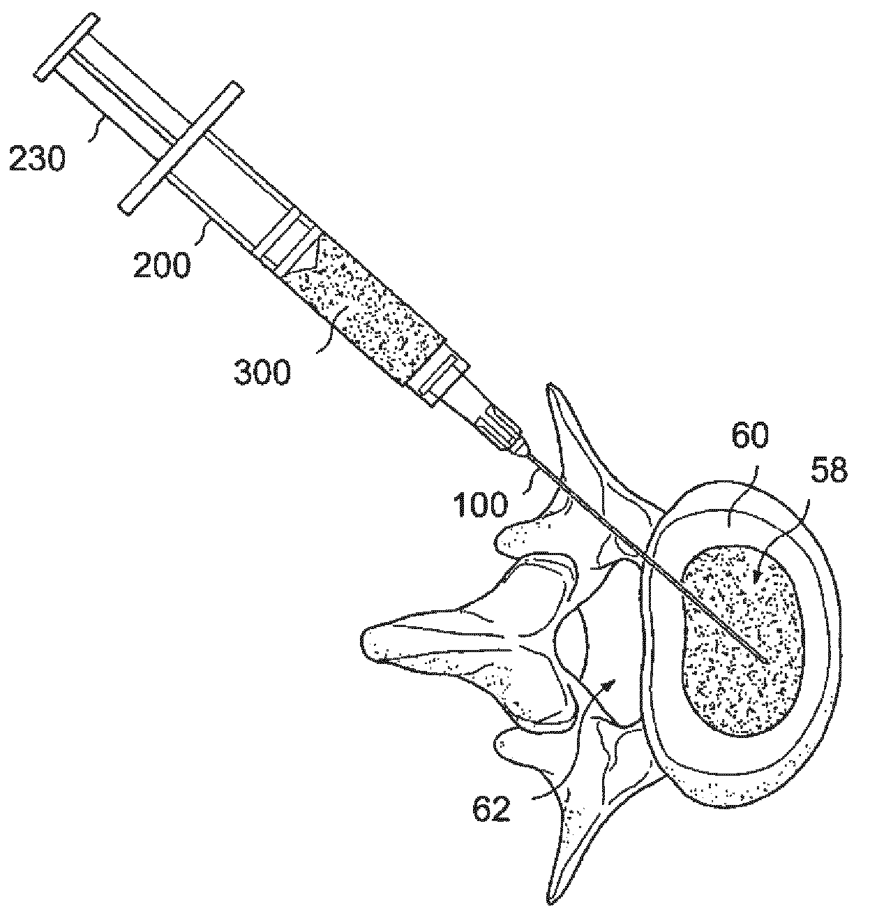 Particle delivery