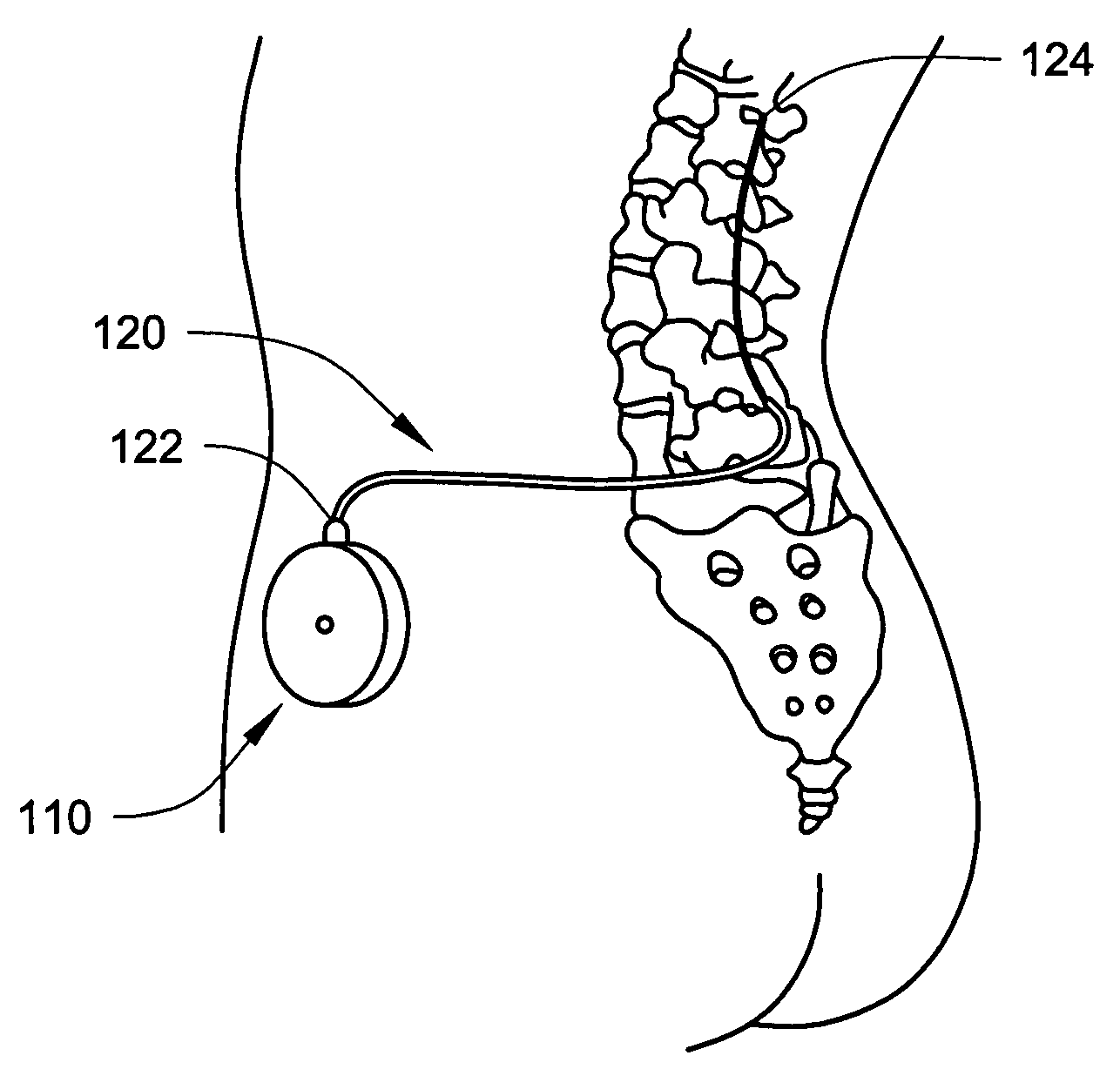 Catheter malfunction determinations using physiologic pressure