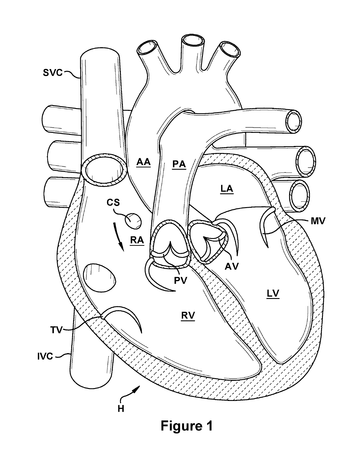 Native valve repair devices and procedures