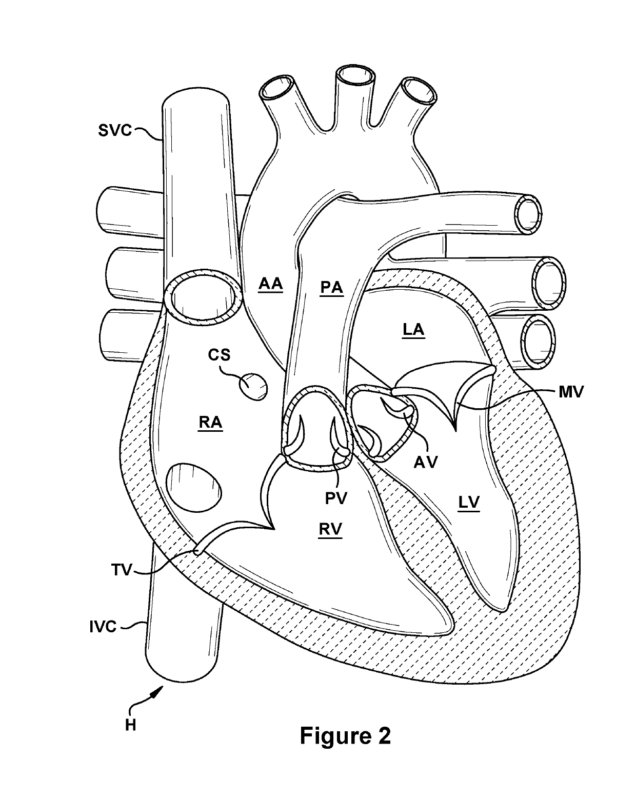 Native valve repair devices and procedures