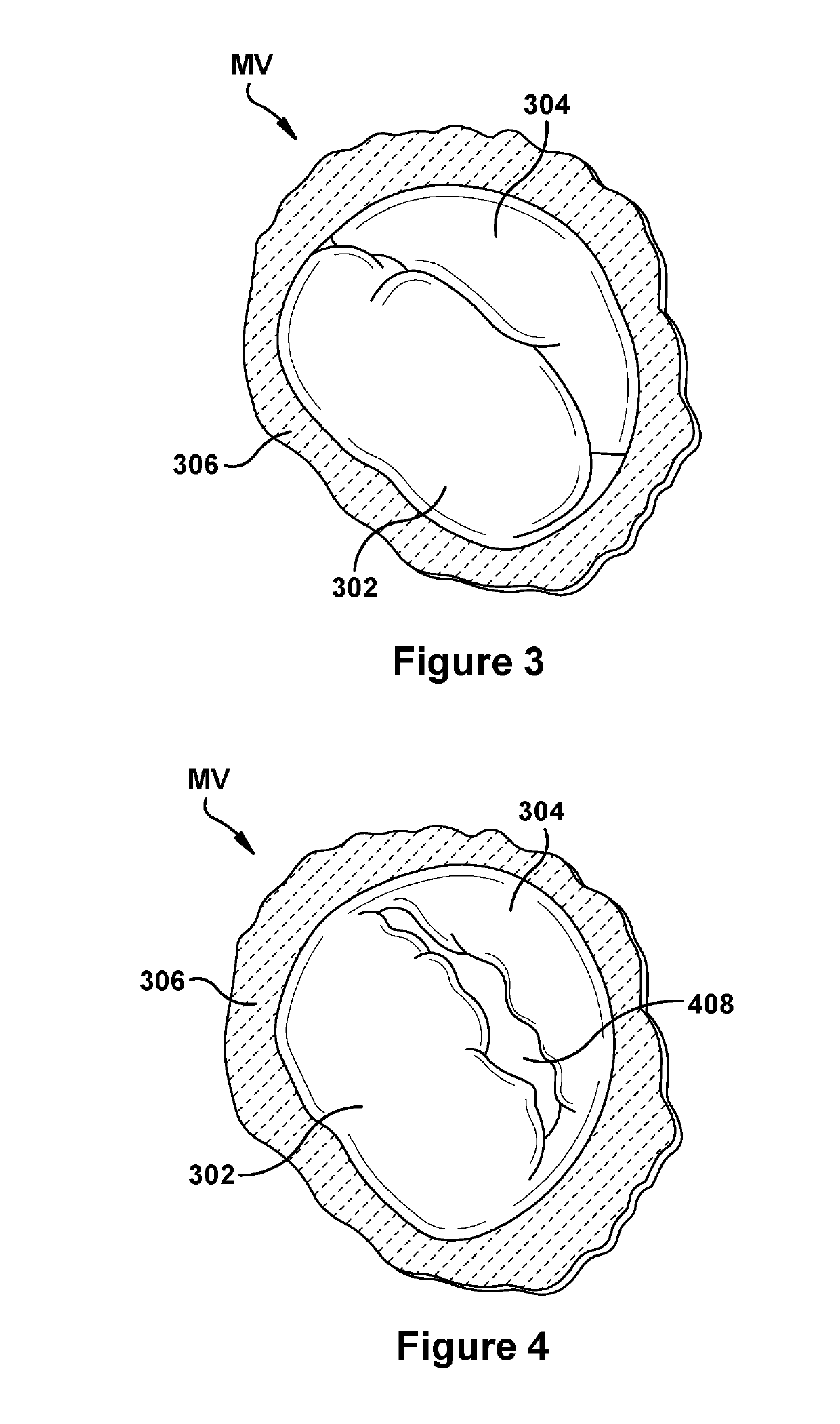 Native valve repair devices and procedures