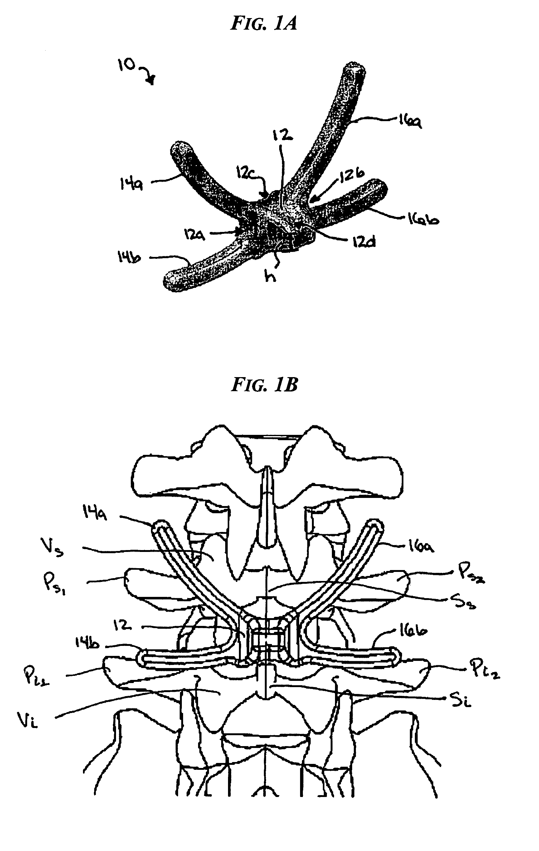 Posterior dynamic stabilization y-device