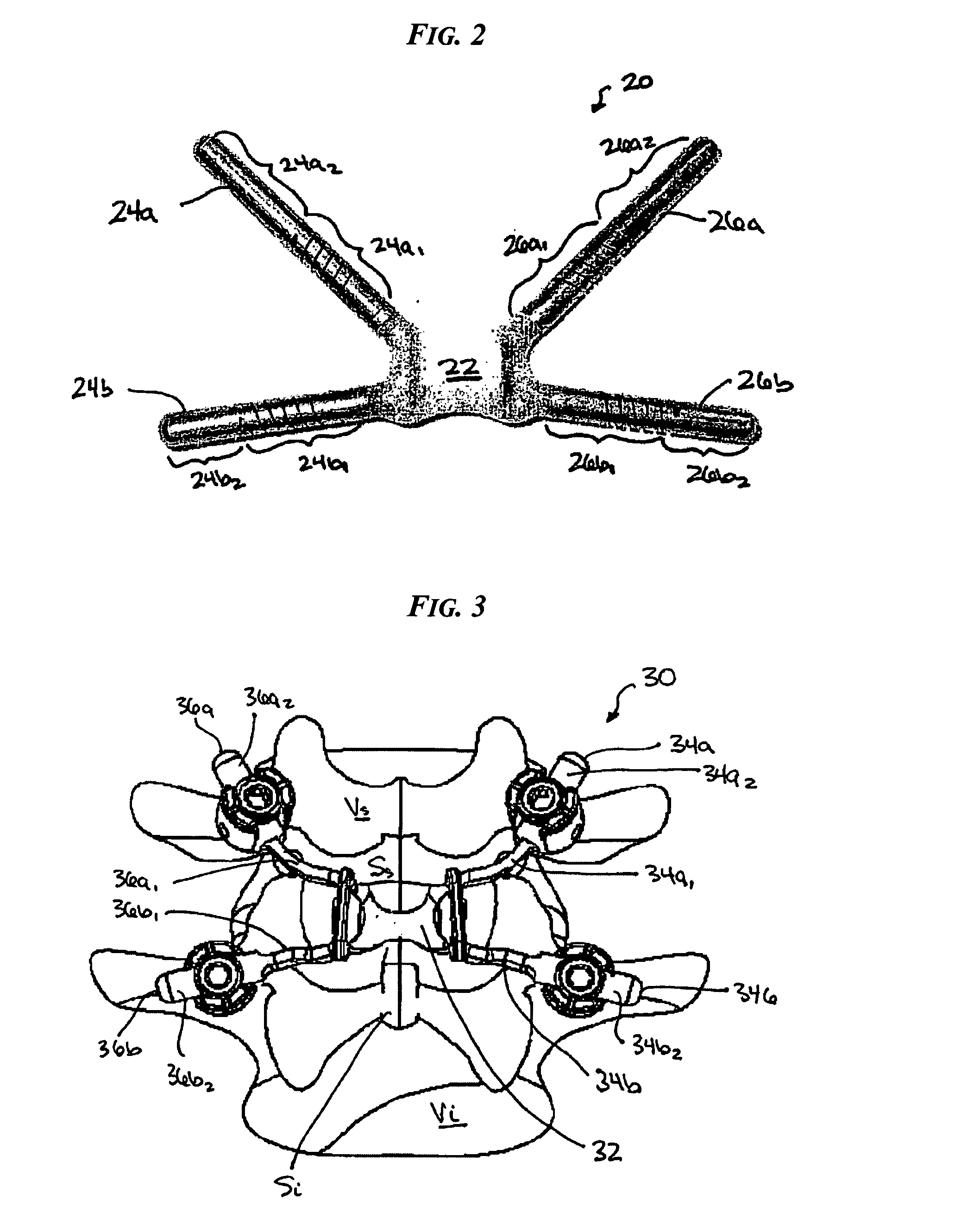 Posterior dynamic stabilization y-device