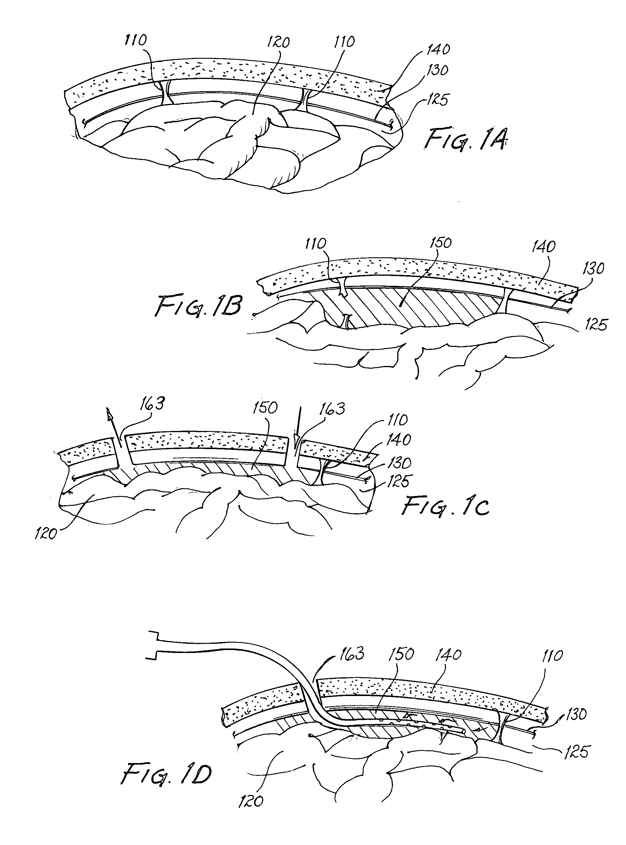 Method and apparatus for irrigation and drainage of the brain's subdural space using a percutaneous approach