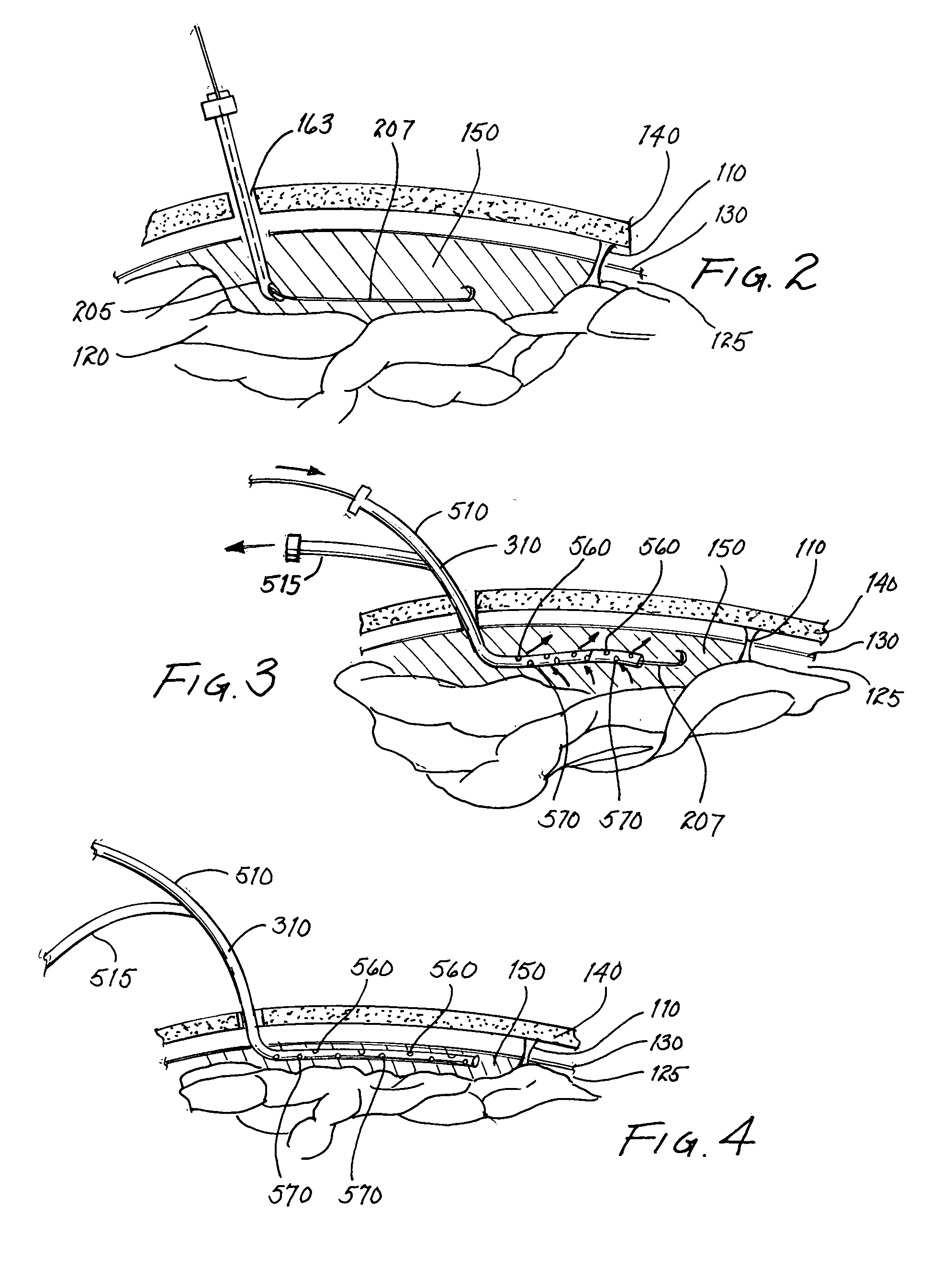 Method and apparatus for irrigation and drainage of the brain's subdural space using a percutaneous approach