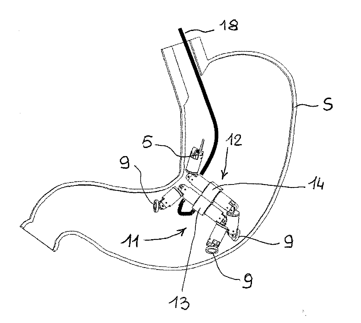 Endoluminal robotic system