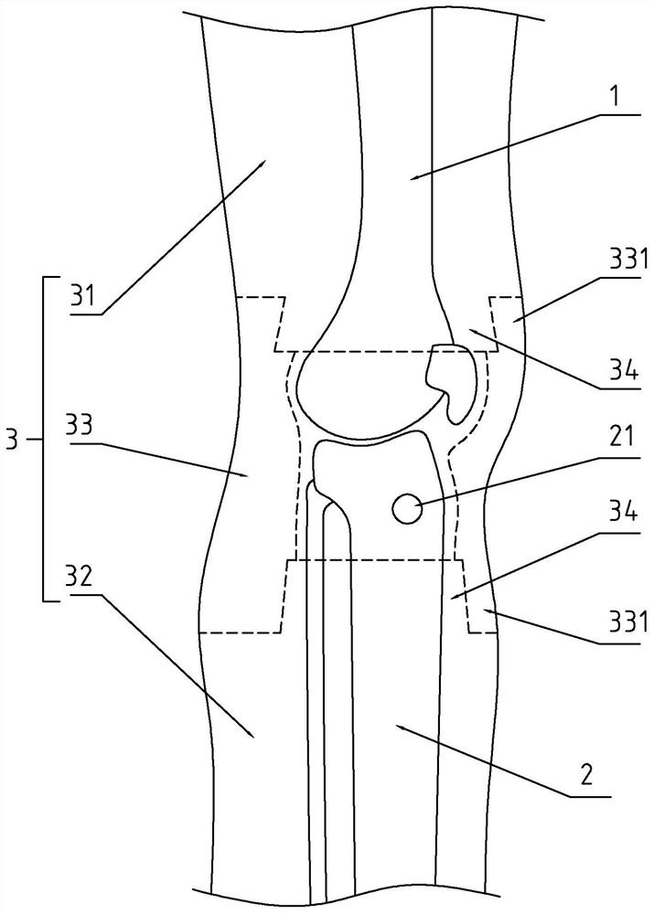 Teaching model for tibial tuberosity bone traction operation