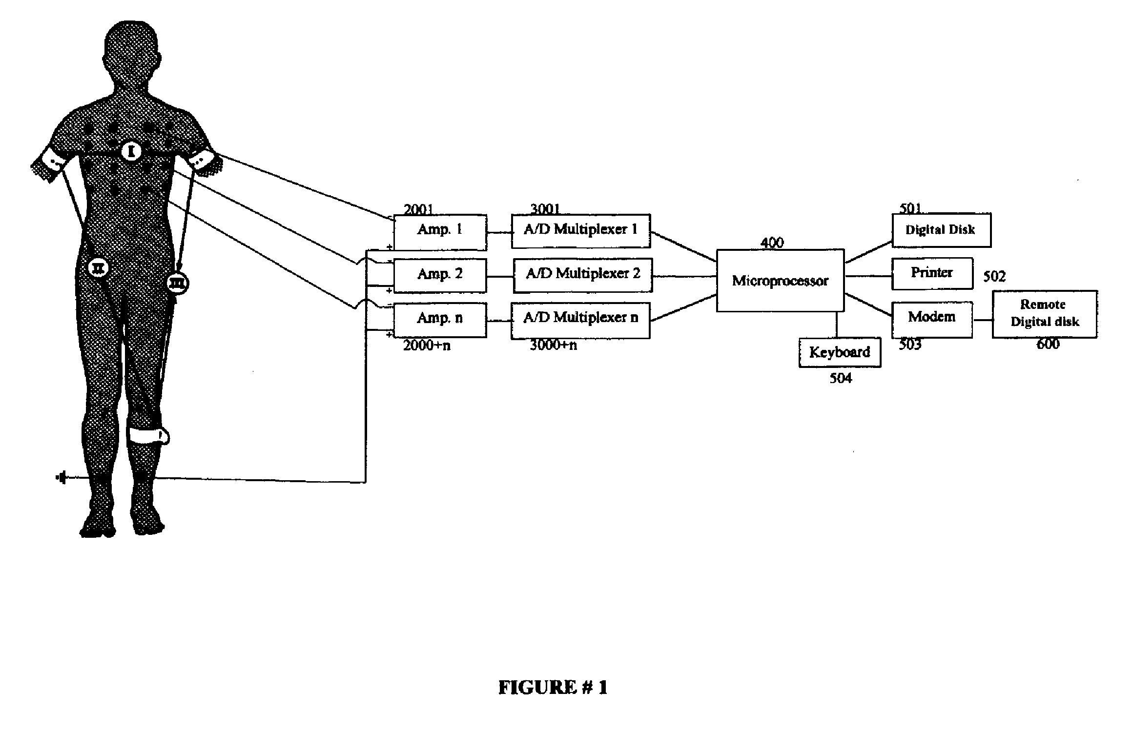 Bipolar, Non-Vectorial Electrocardiography