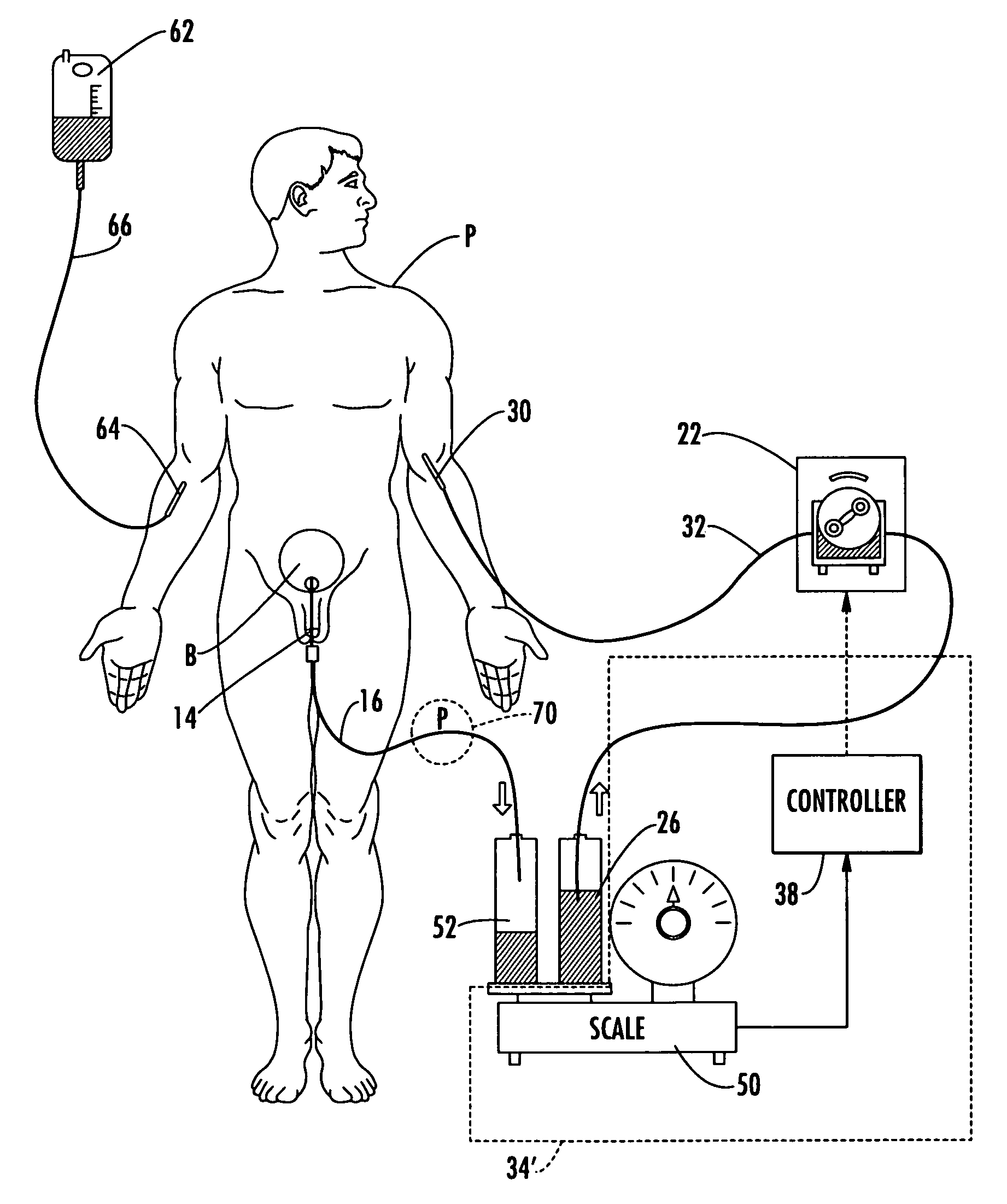 Patient hydration system with abnormal condition sensing