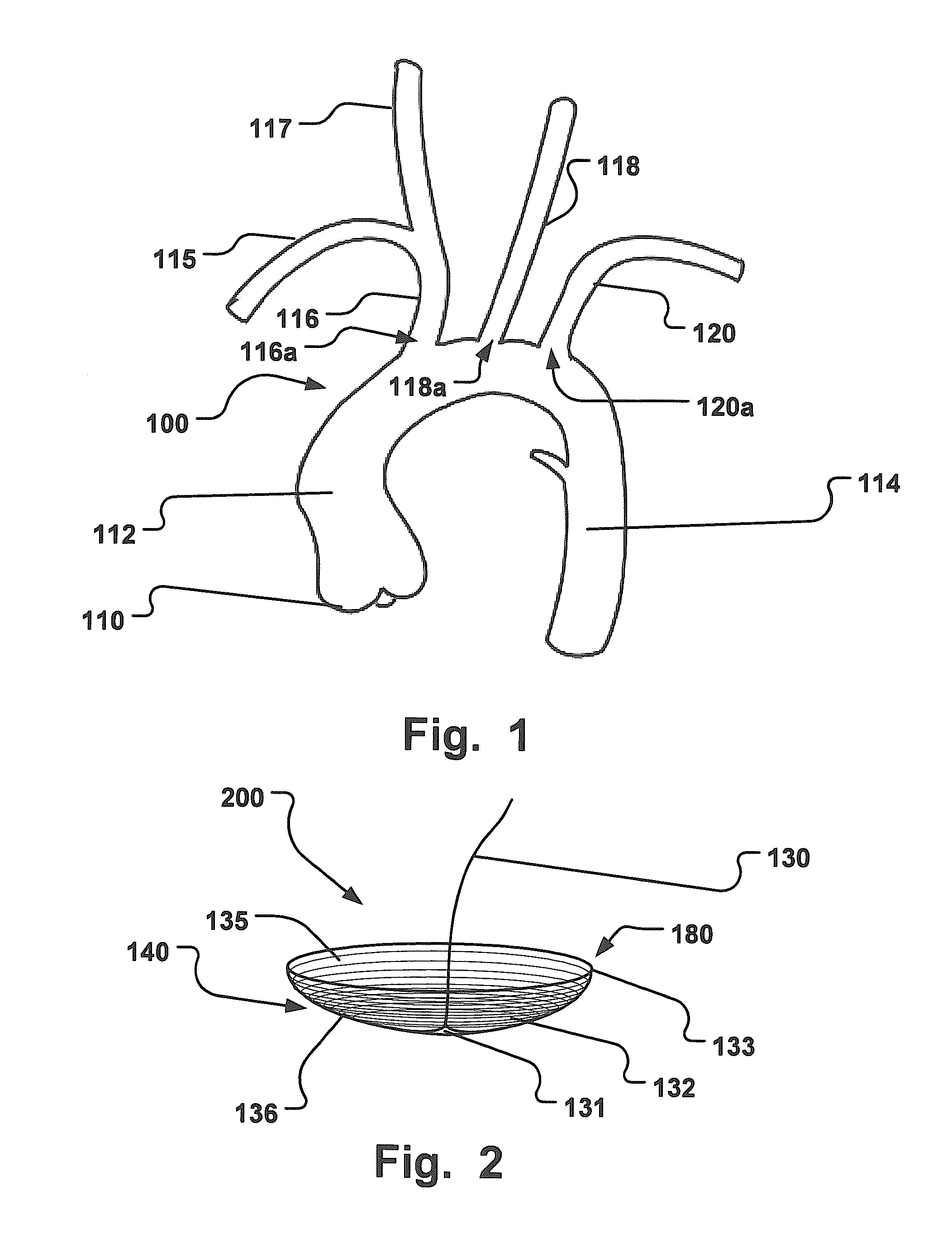 Temporary Embolic Protection Device And Medical Procedure For Delivery Thereof