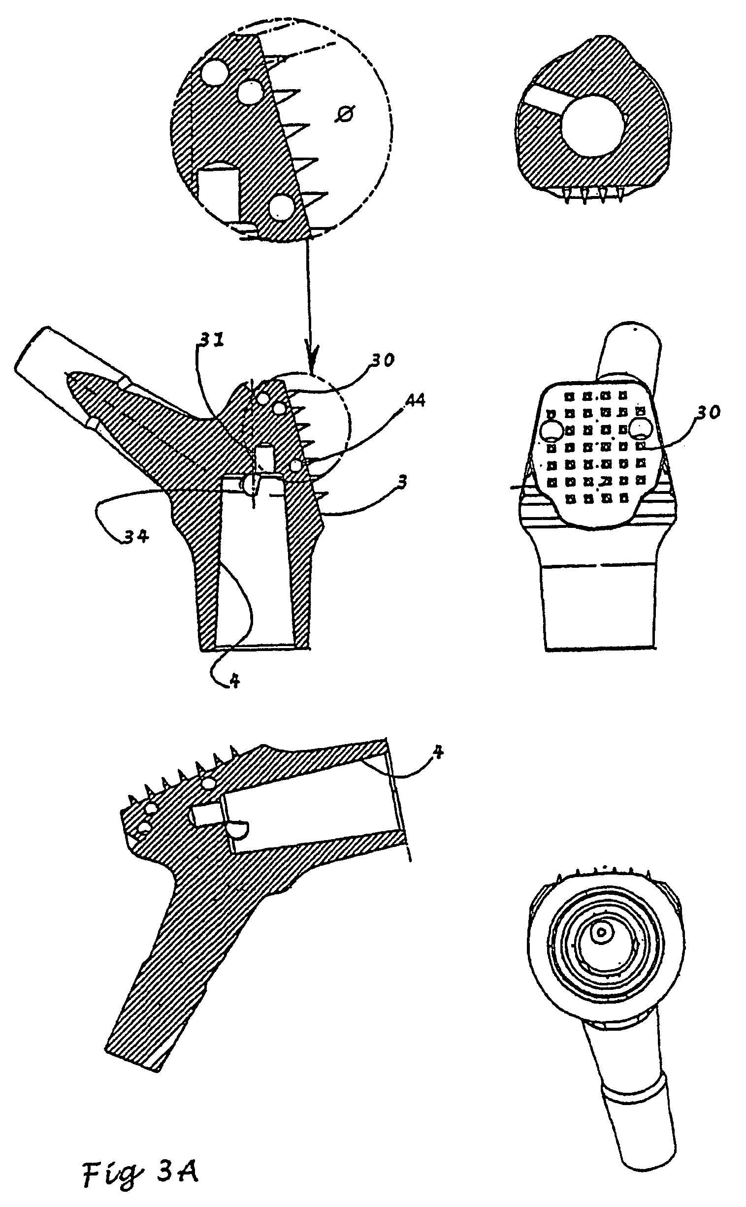 Modular long bone prosthesis