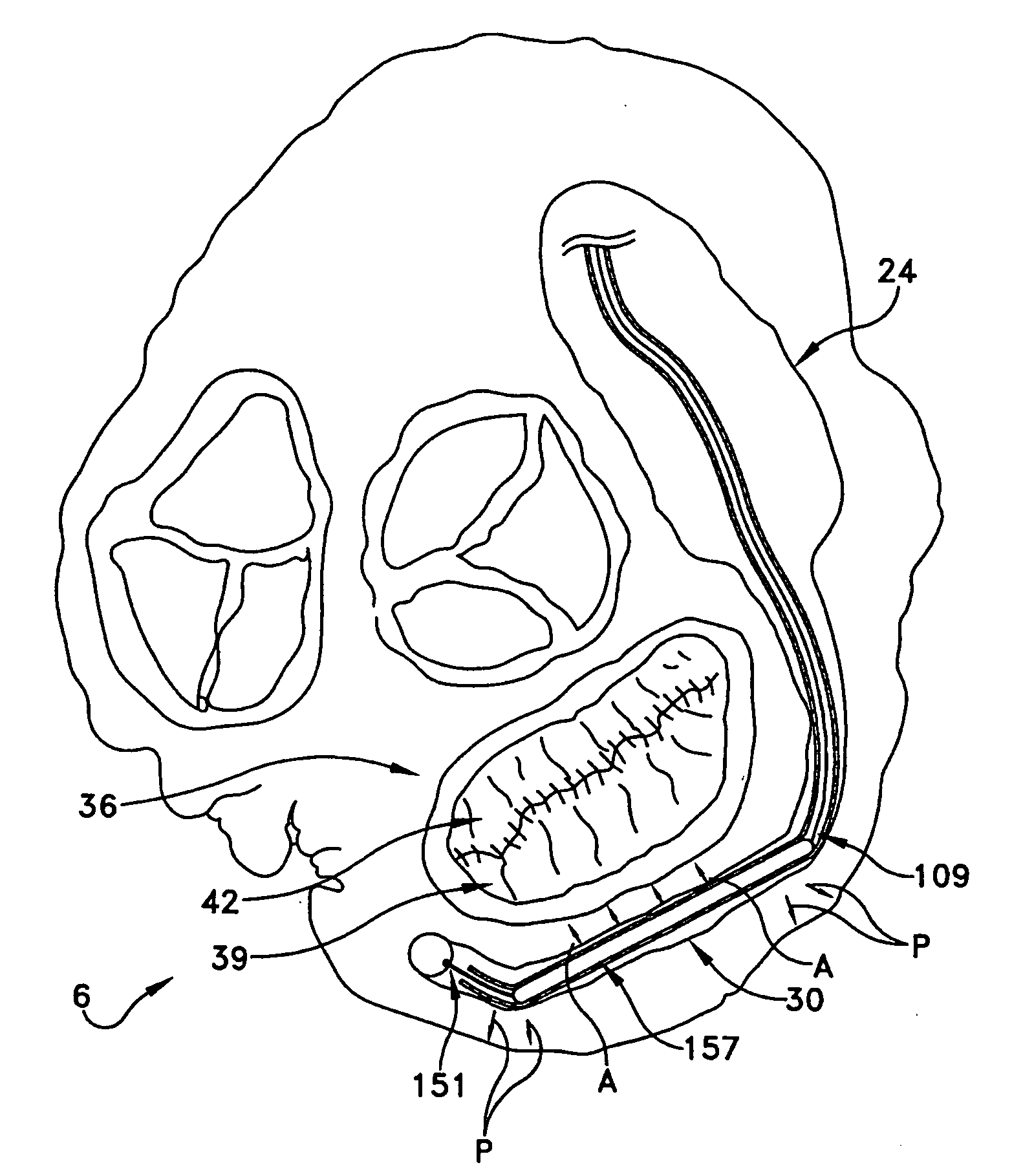 Method and apparatus for reducing mitral regurgitation