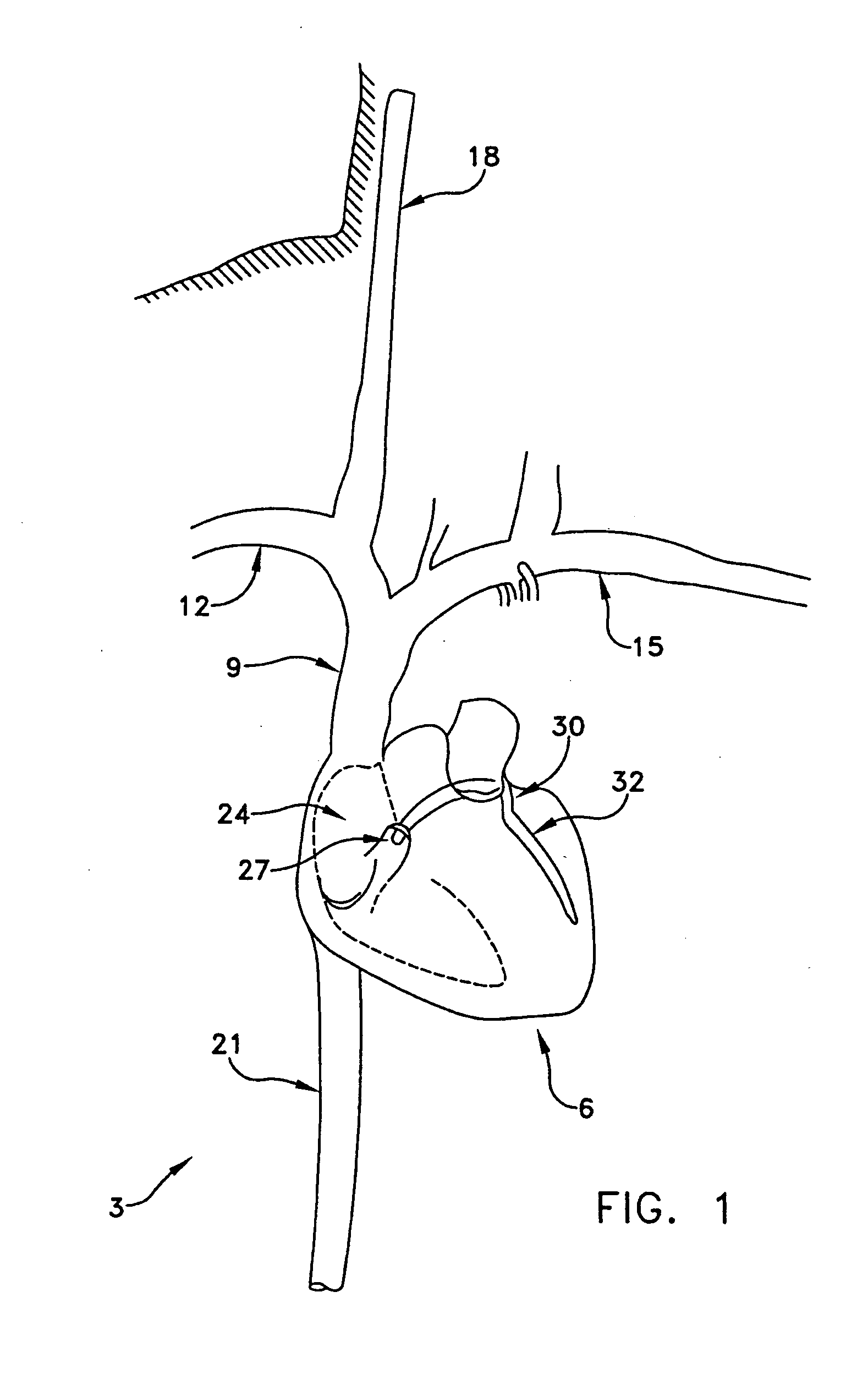 Method and apparatus for reducing mitral regurgitation