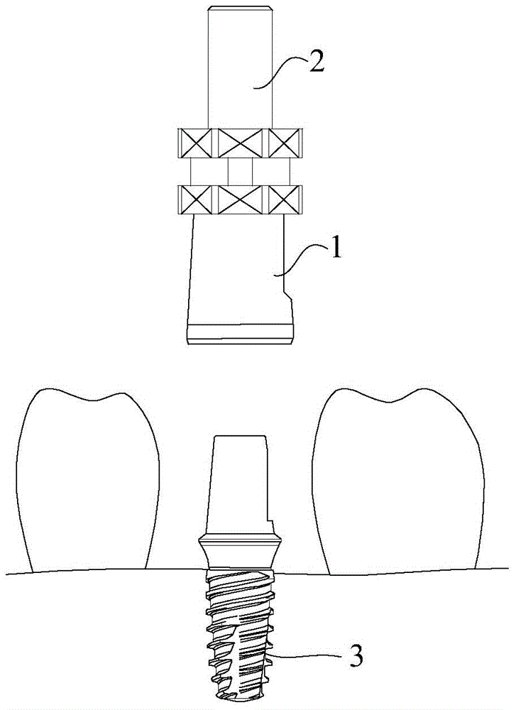 Impression auxiliary cap for dental implant surgery, and impression method