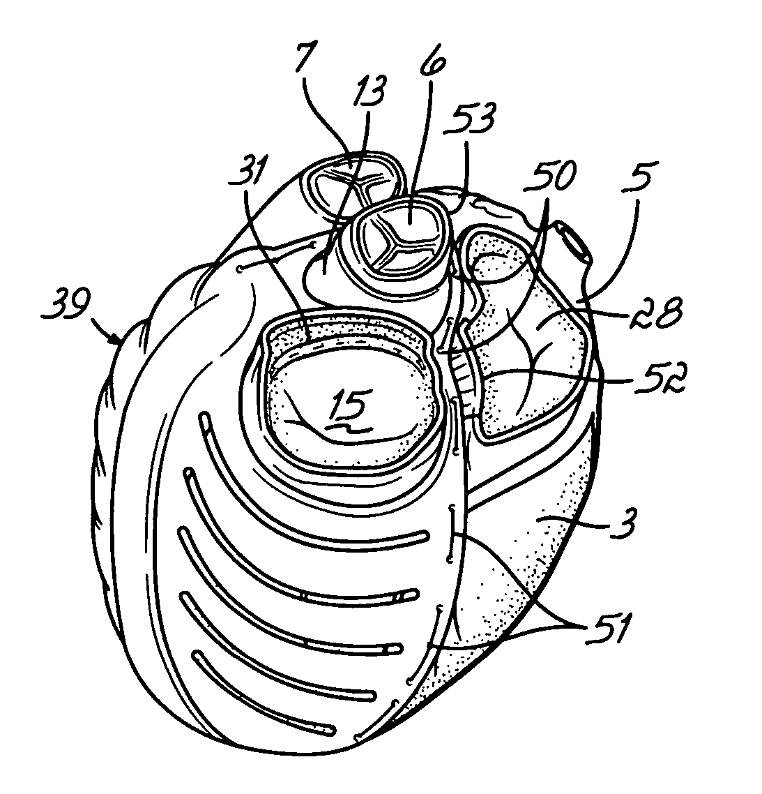 Deforming jacket for a heart actuation device