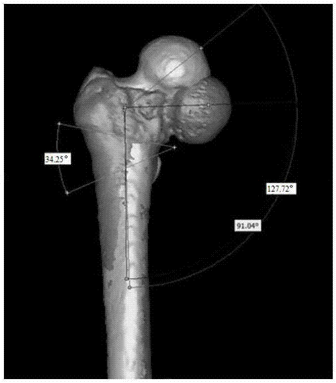 Computer-aided design orthopedics department osteotomy, orthotics and immobilization integrated guide plate and manufacturing method