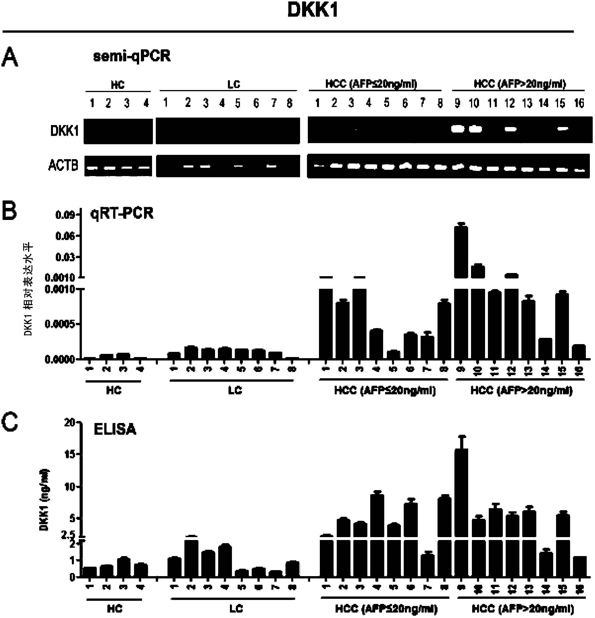 Application of DKK1 as diagnostic marker