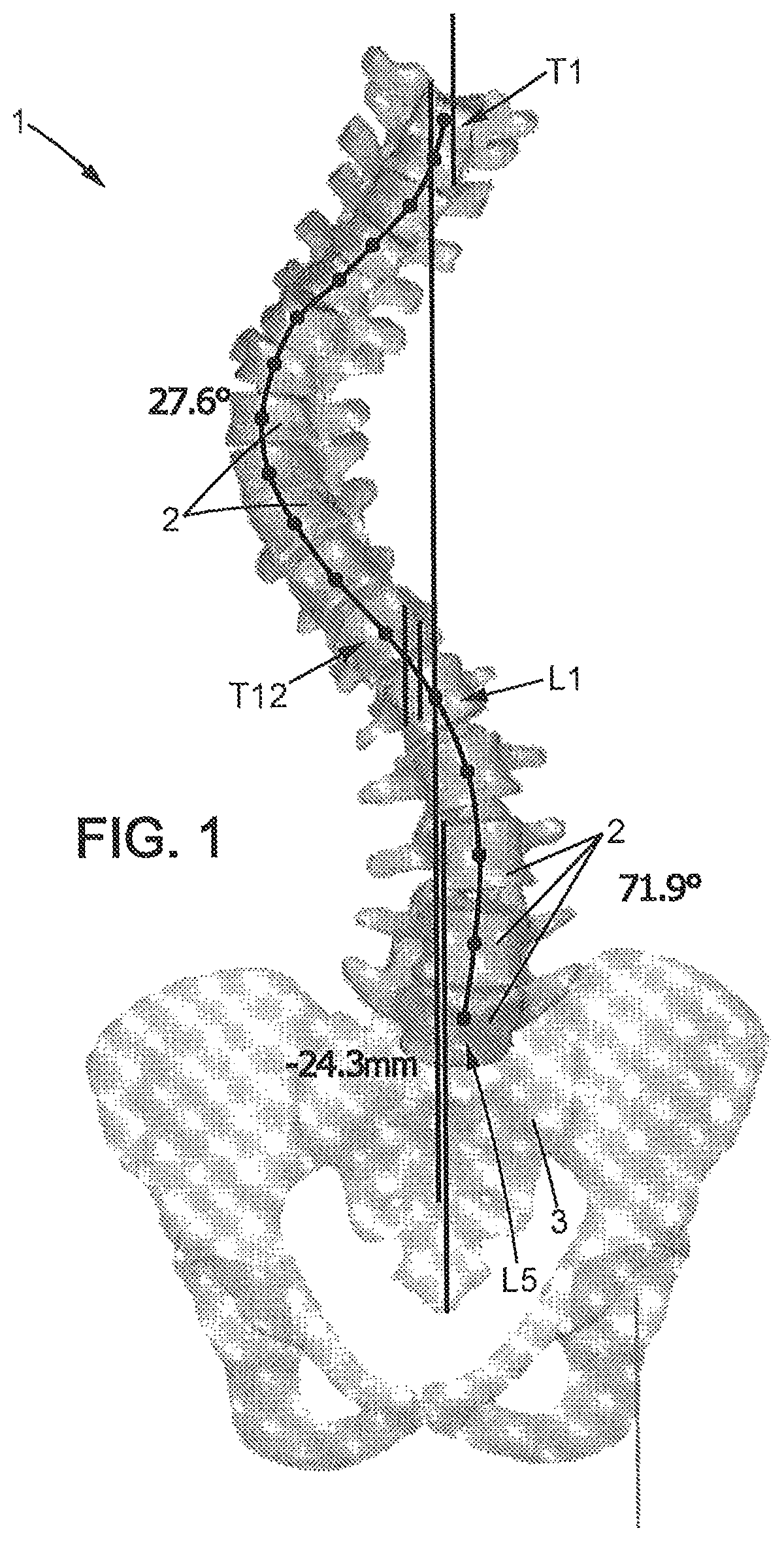 Method of preoperative planning to correct spine misalignment of a patient