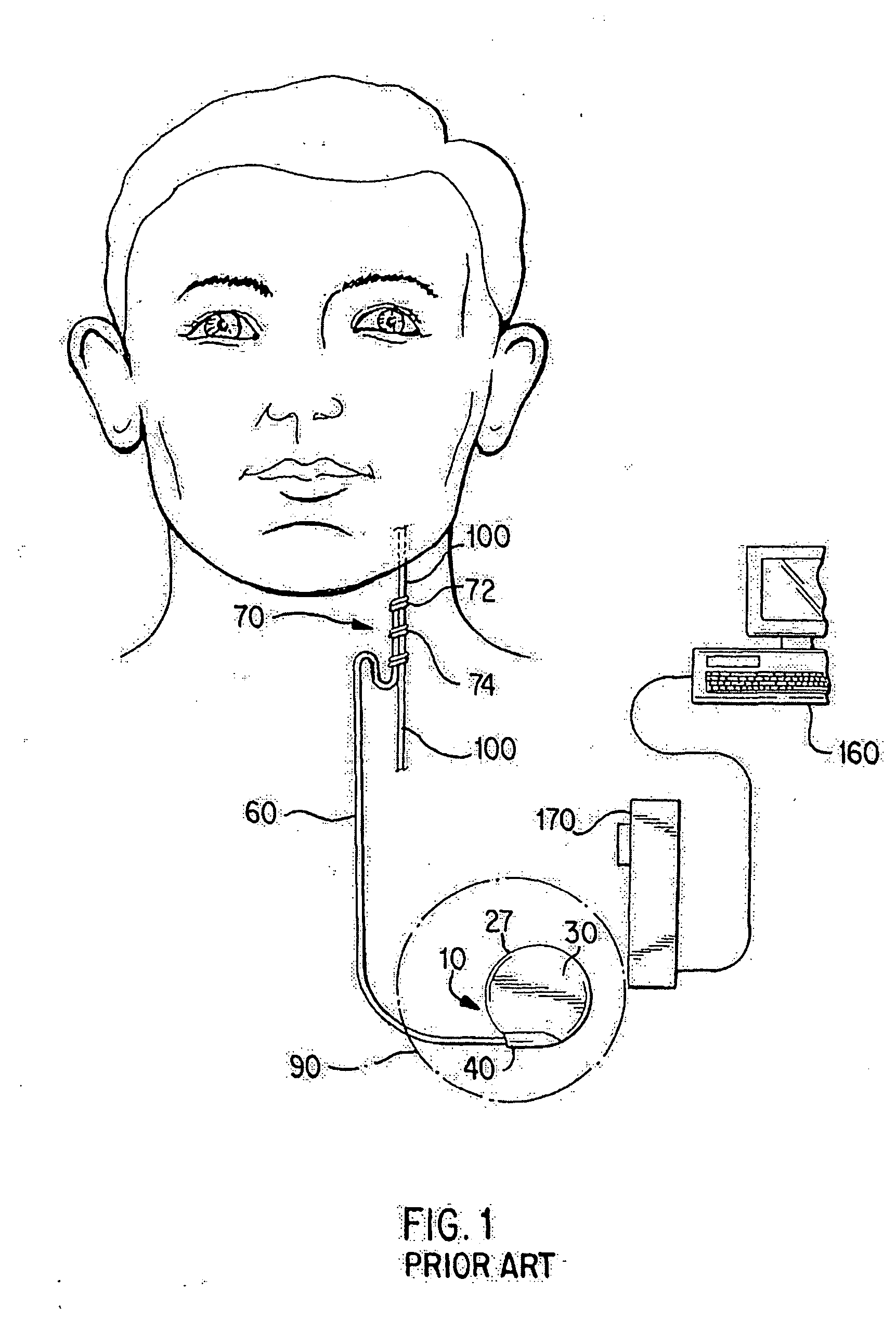 Neurostimulation with activation based on changes in body temperature