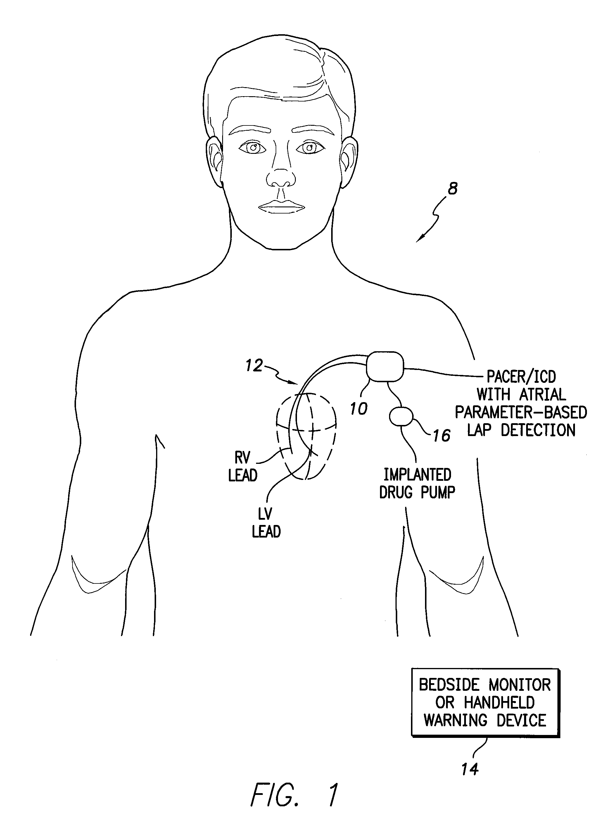 System and method for exploiting atrial electrocardiac parameters in assessing left atrial pressure using an implantable medical device