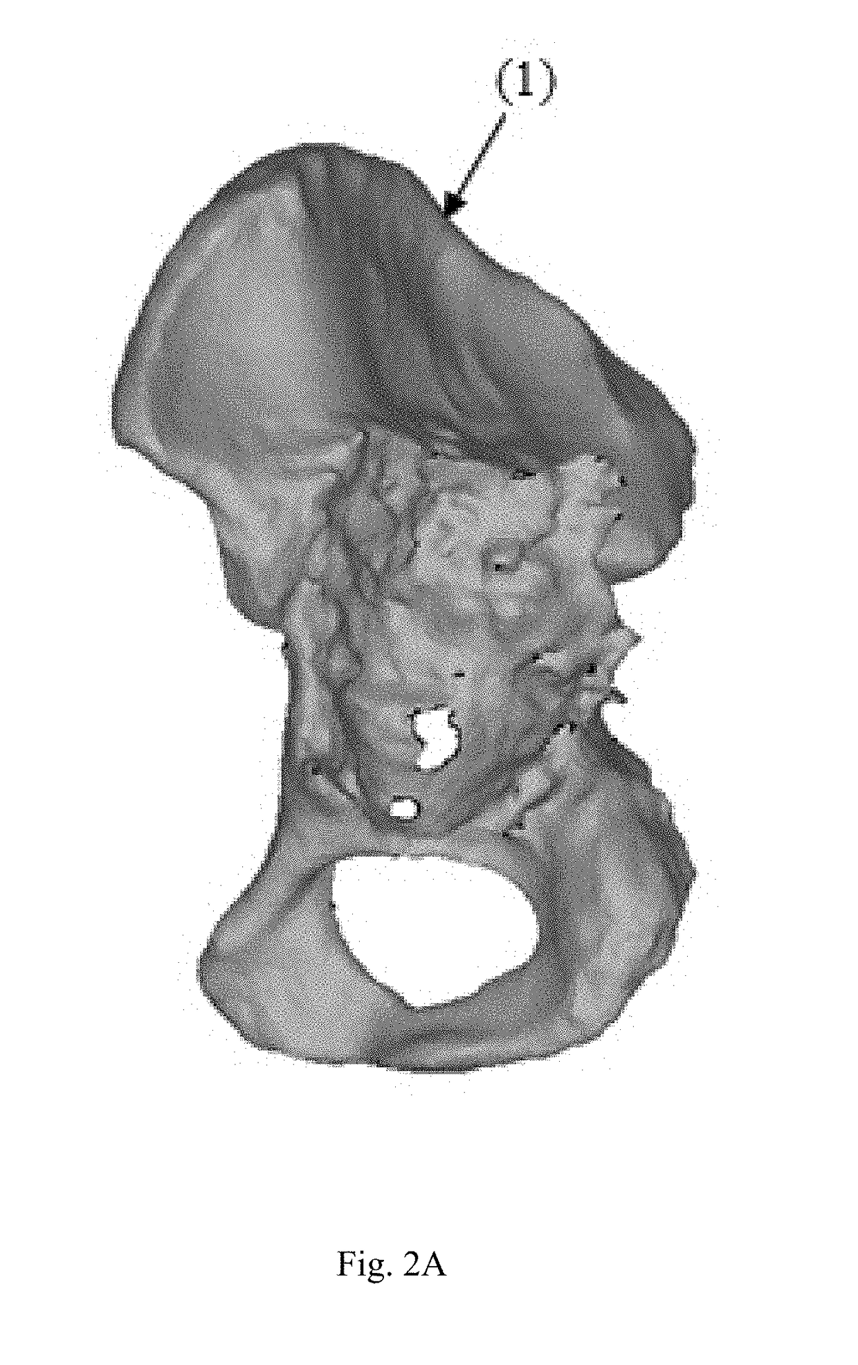 Customized surgical guides, methods for manufacturing and uses thereof