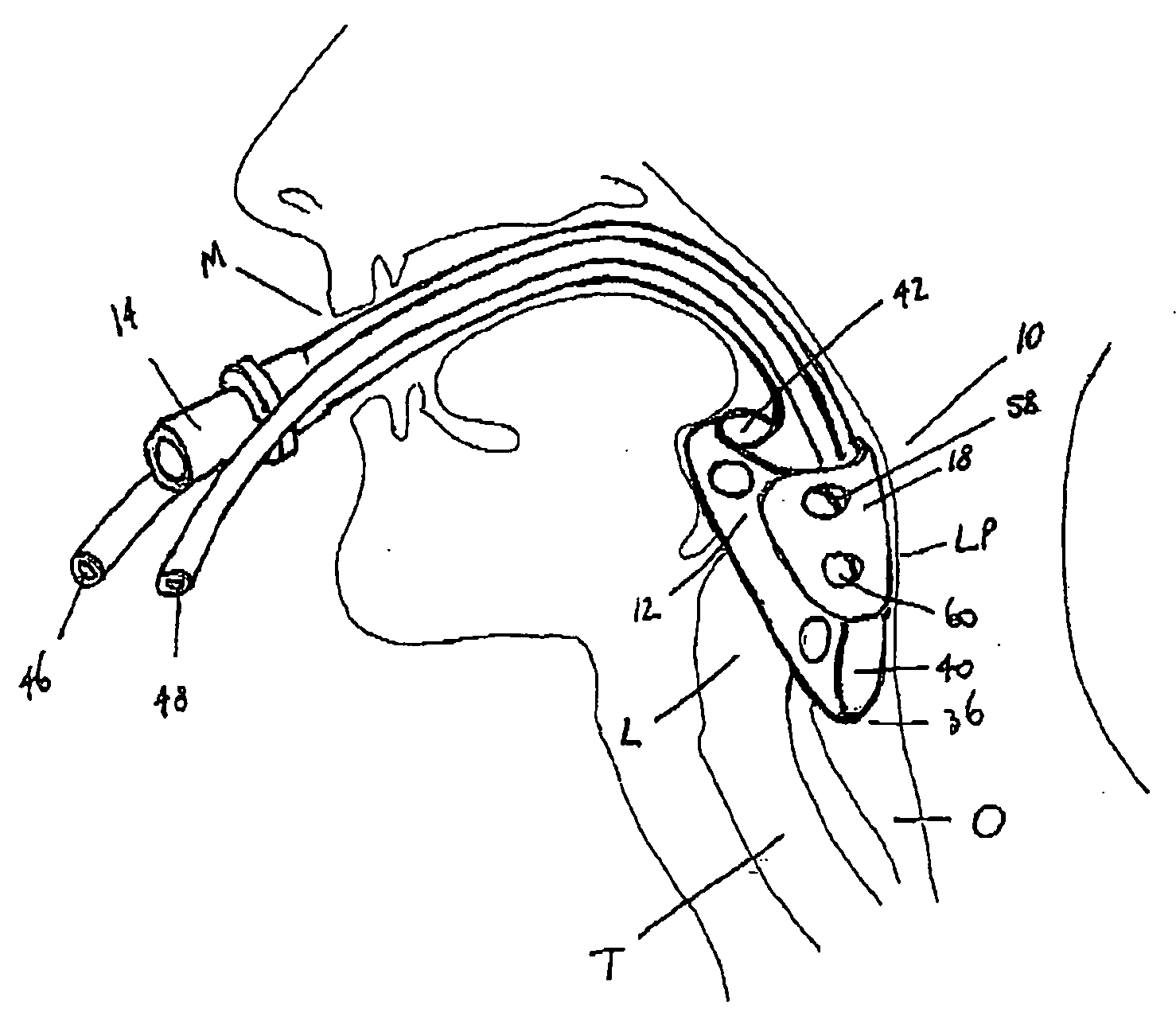 Laryngeal mask