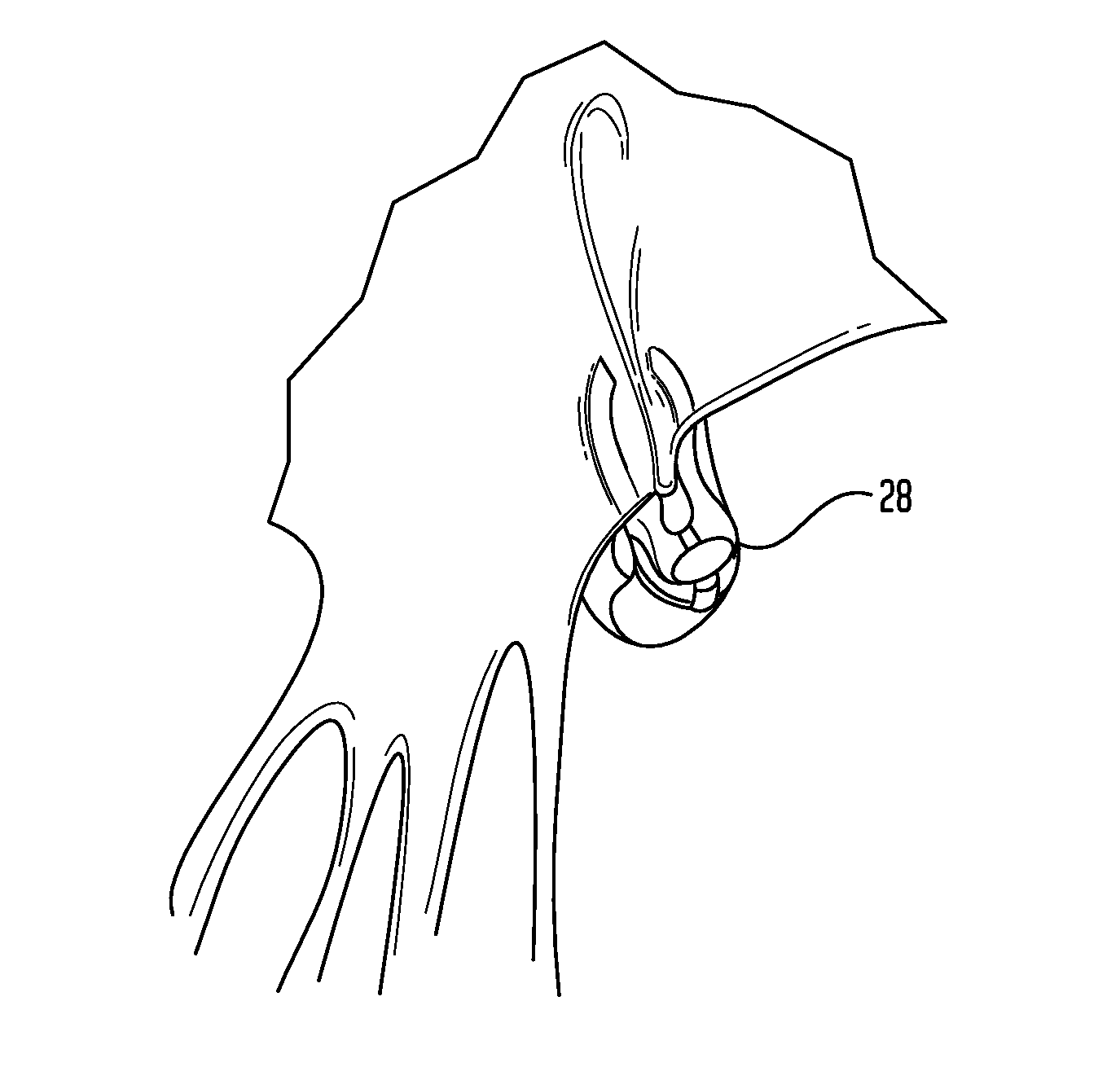 Apparatus and method for heart valve repair