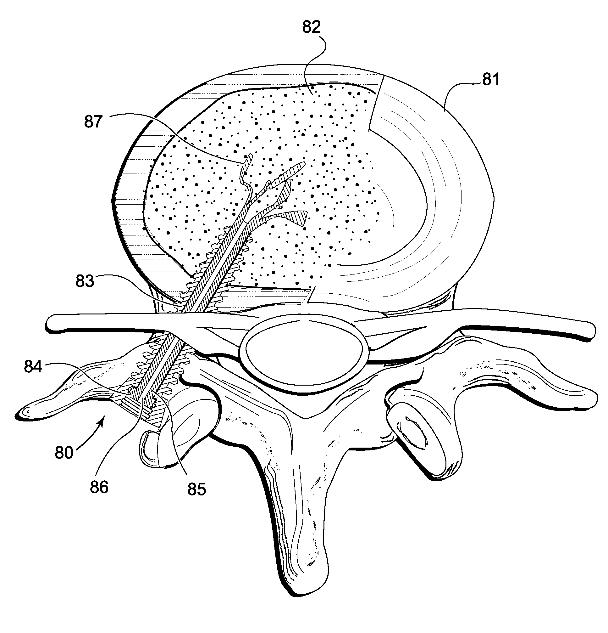 Device and method for orthopedic fracture fixation