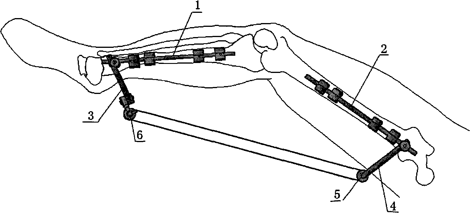 External fixing rack gradually pulling device for treating stiff knee