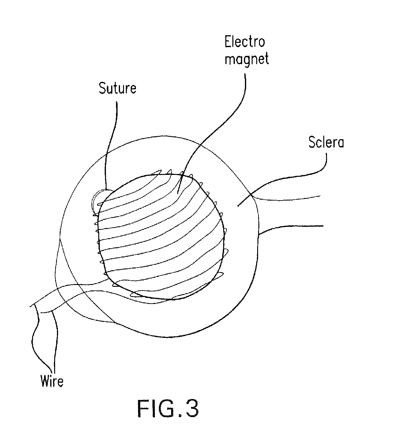 Method and composition for hyperthermally treating cells