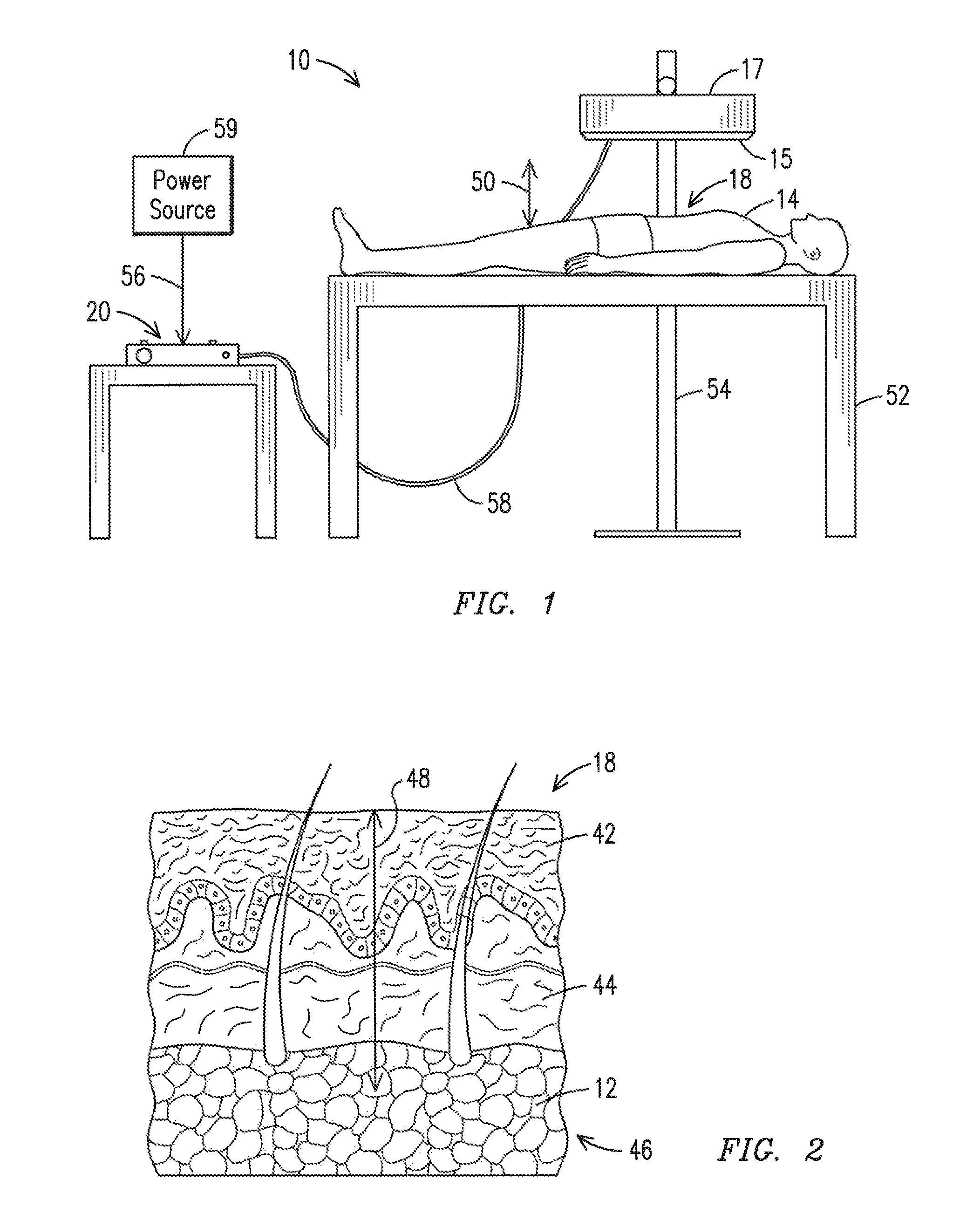 System and method for reducing lipid content of adipocytes in a body