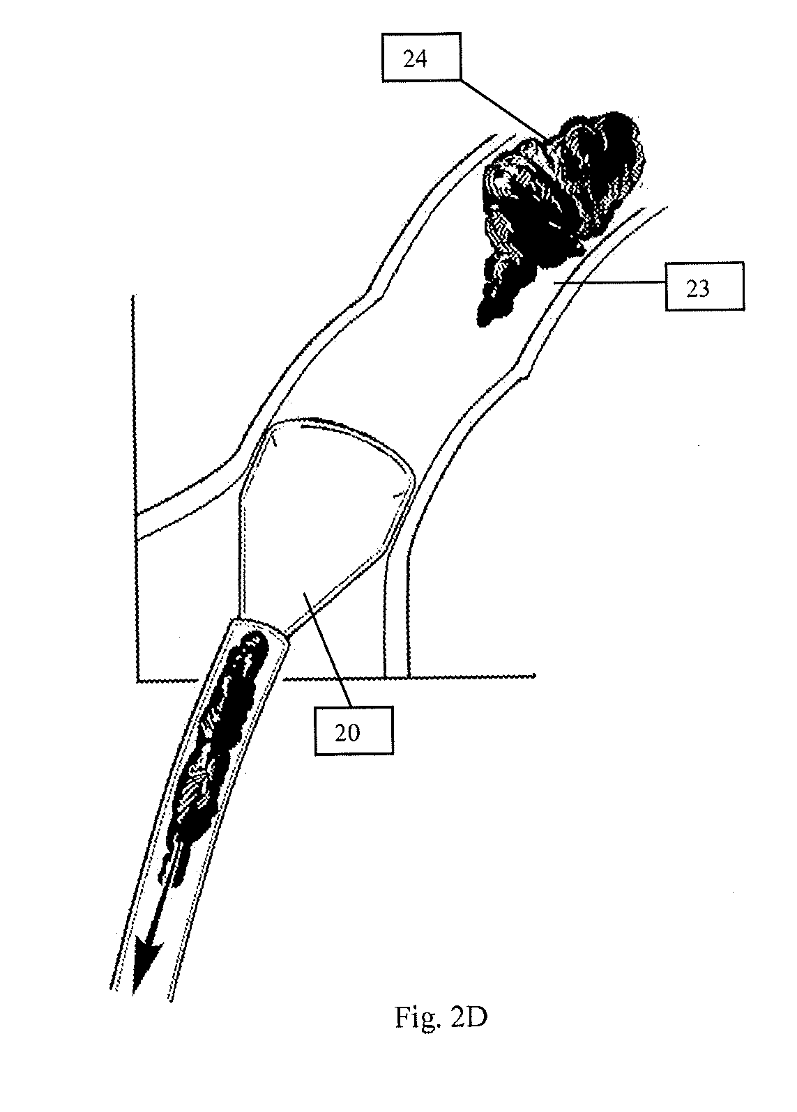 System and Methods for Removing Undesirable Material within a Circulatory System Utilizing during a Surgical Procedure