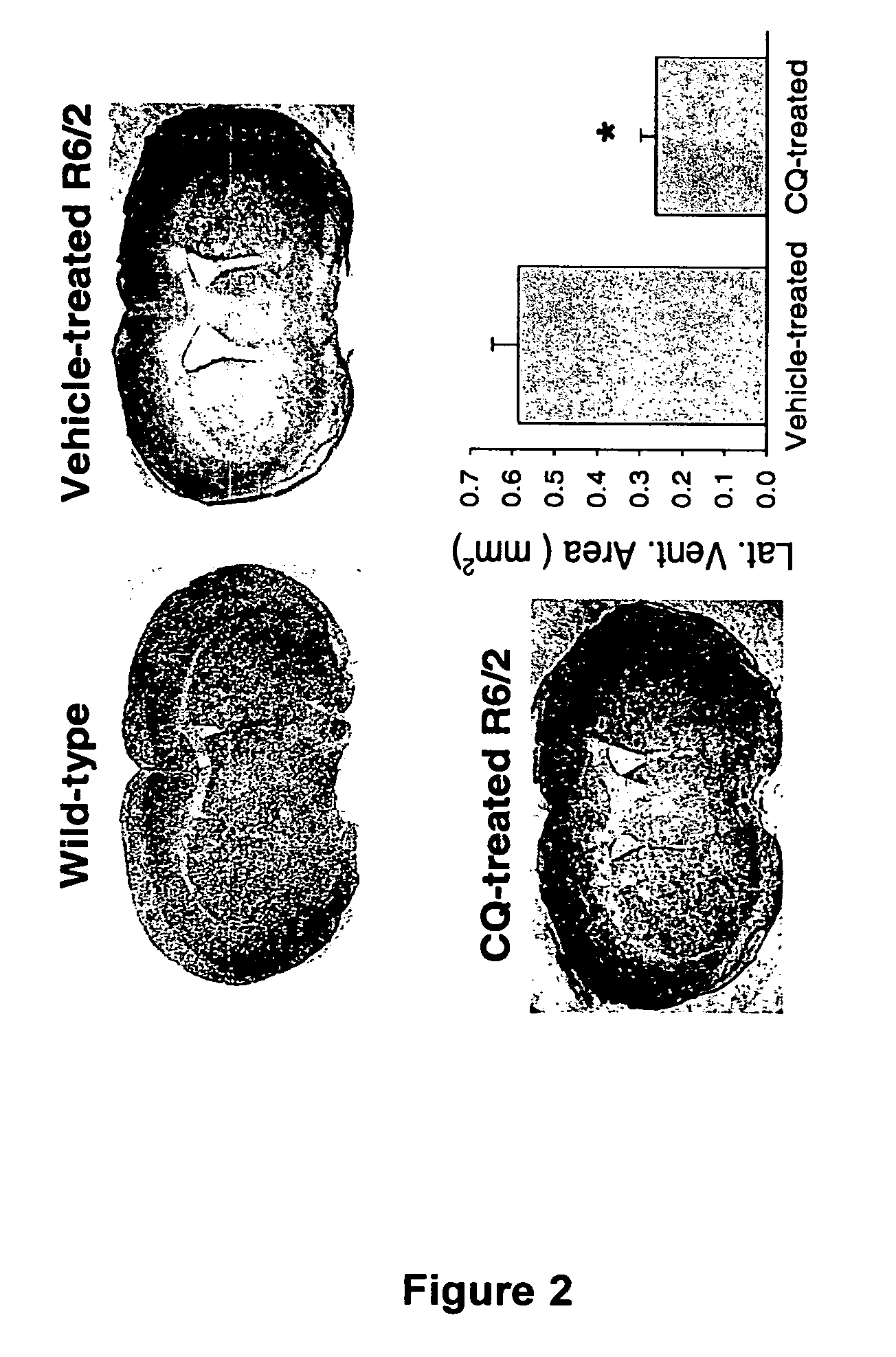 8-hydroxyquinoline compounds for treating a polyglutamine (polyQ)-expansion disease