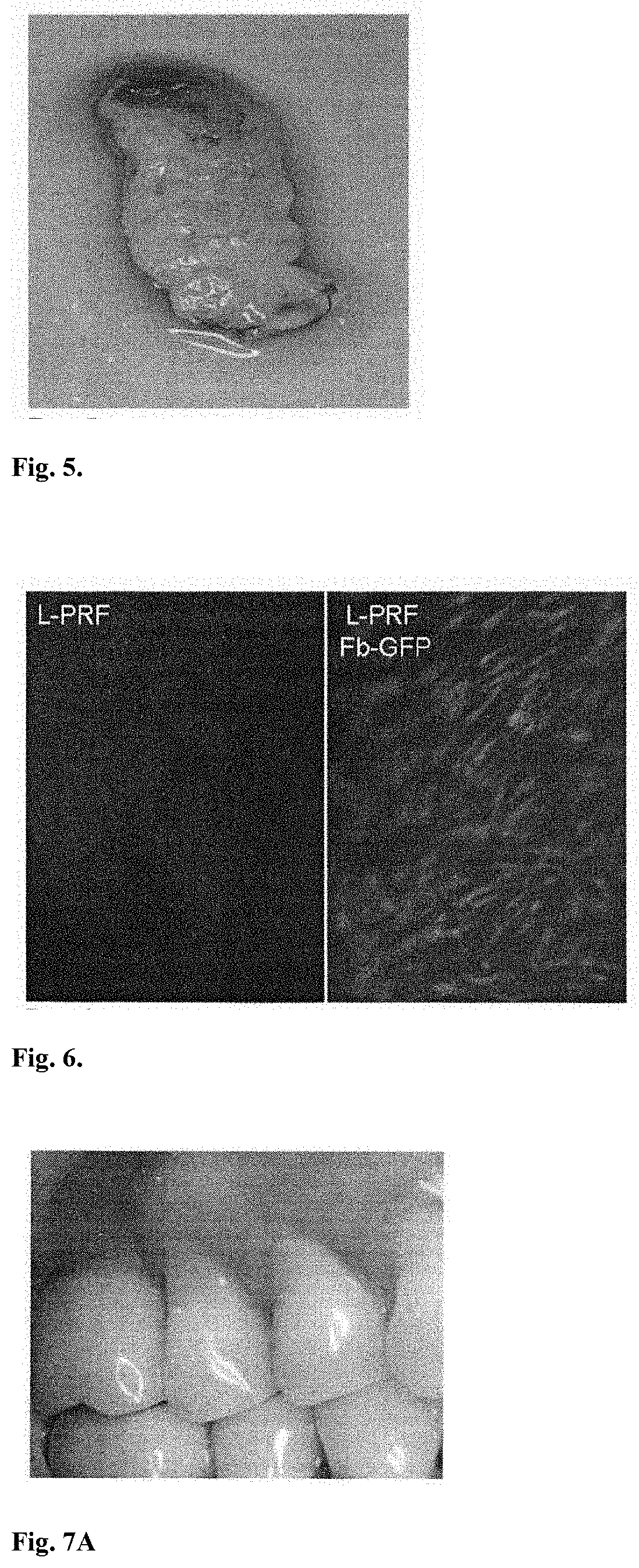 Biotransplant for treating gum recession and restoring gingival tissue volume