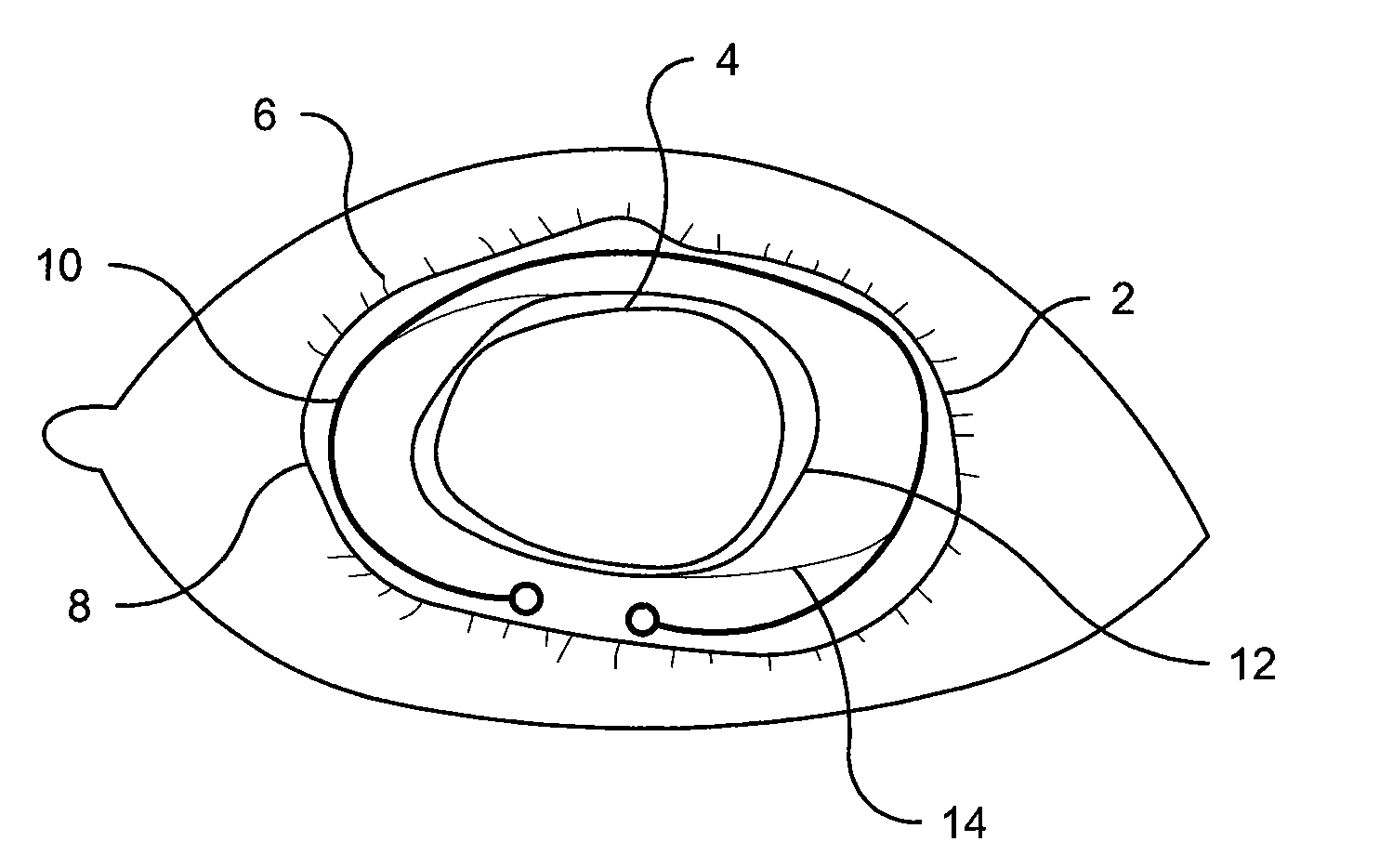 Methods and Devices for Preventing or Delaying Posterior Capsule Opacification