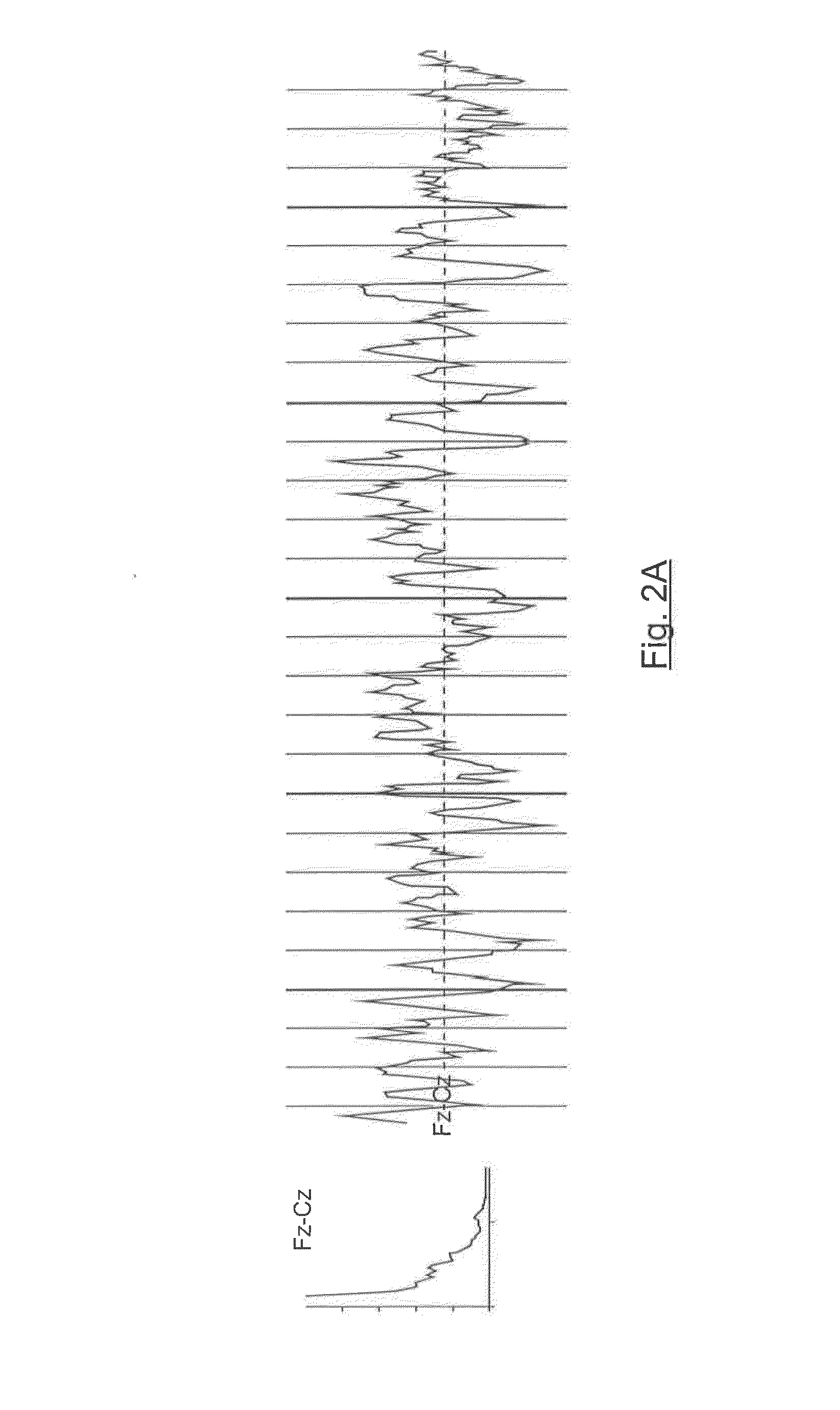 Brain therapy system and method using noninvasive brain stimulation