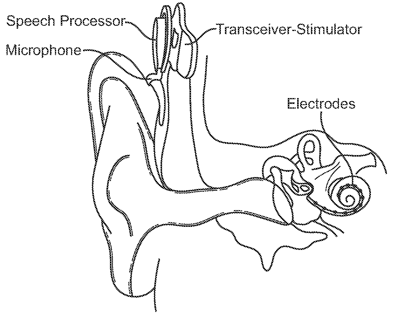 Systems and methods for implantable leadless cochlear stimulation