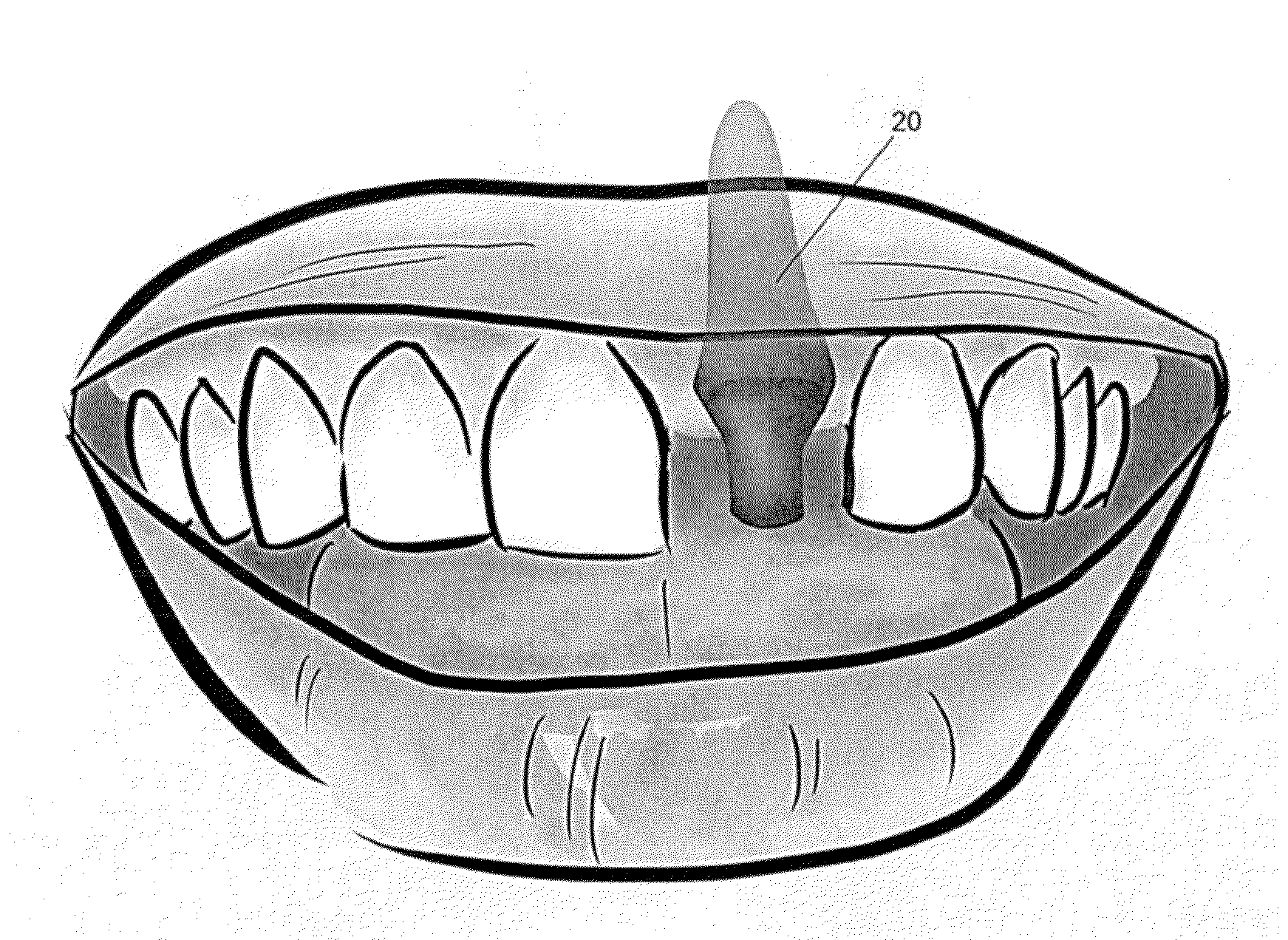 System and Method for Customized Anatomical Implant Prosthetic Pieces