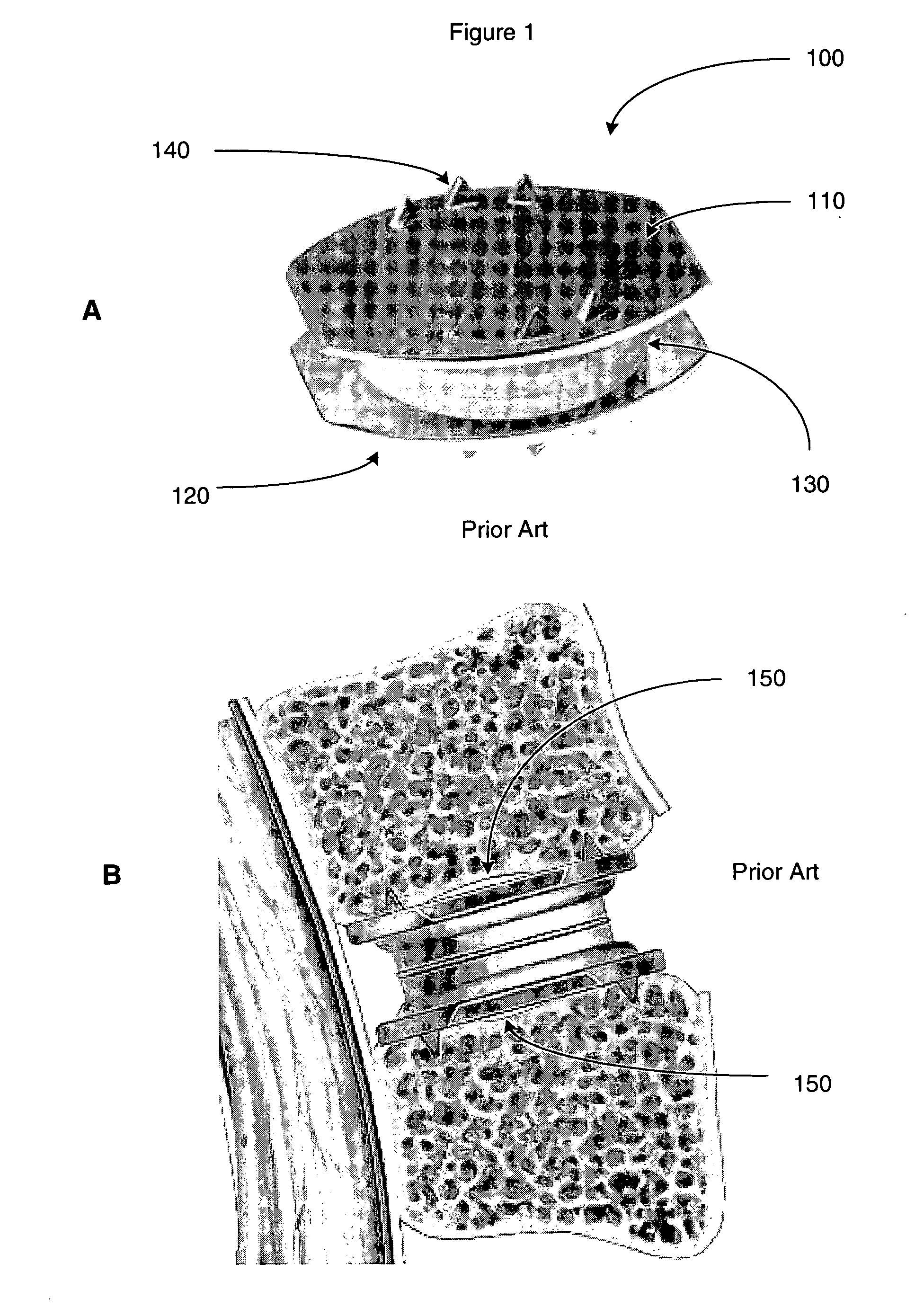 Compliant porous coating