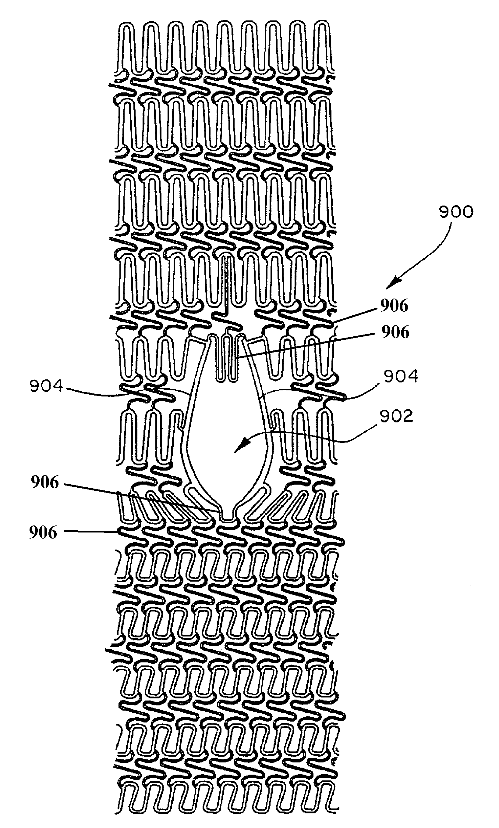 Extendible stent apparatus